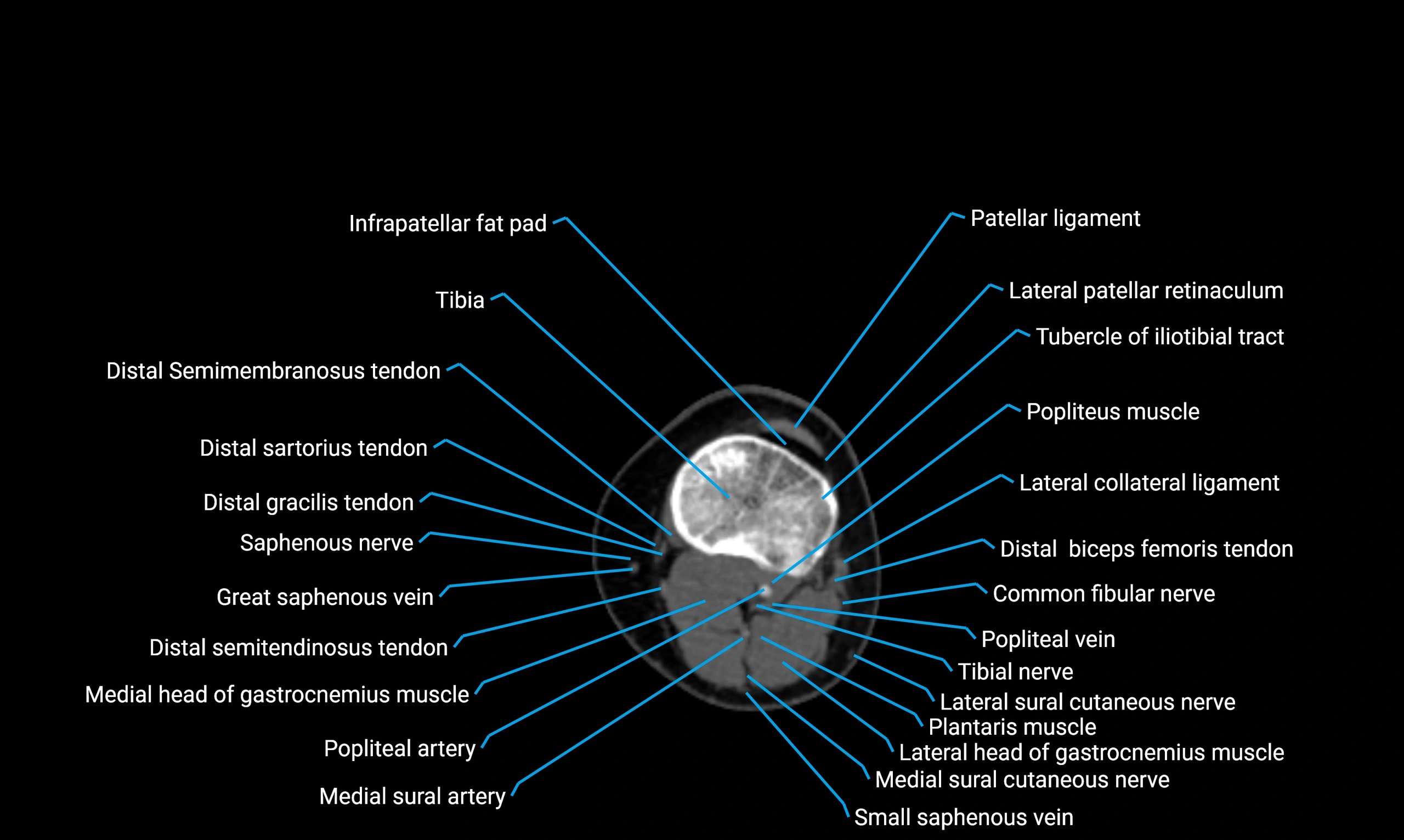 CT Lower Limb Anatomy – Normal Labeled CT Axial, Coronal, Sagittal ...