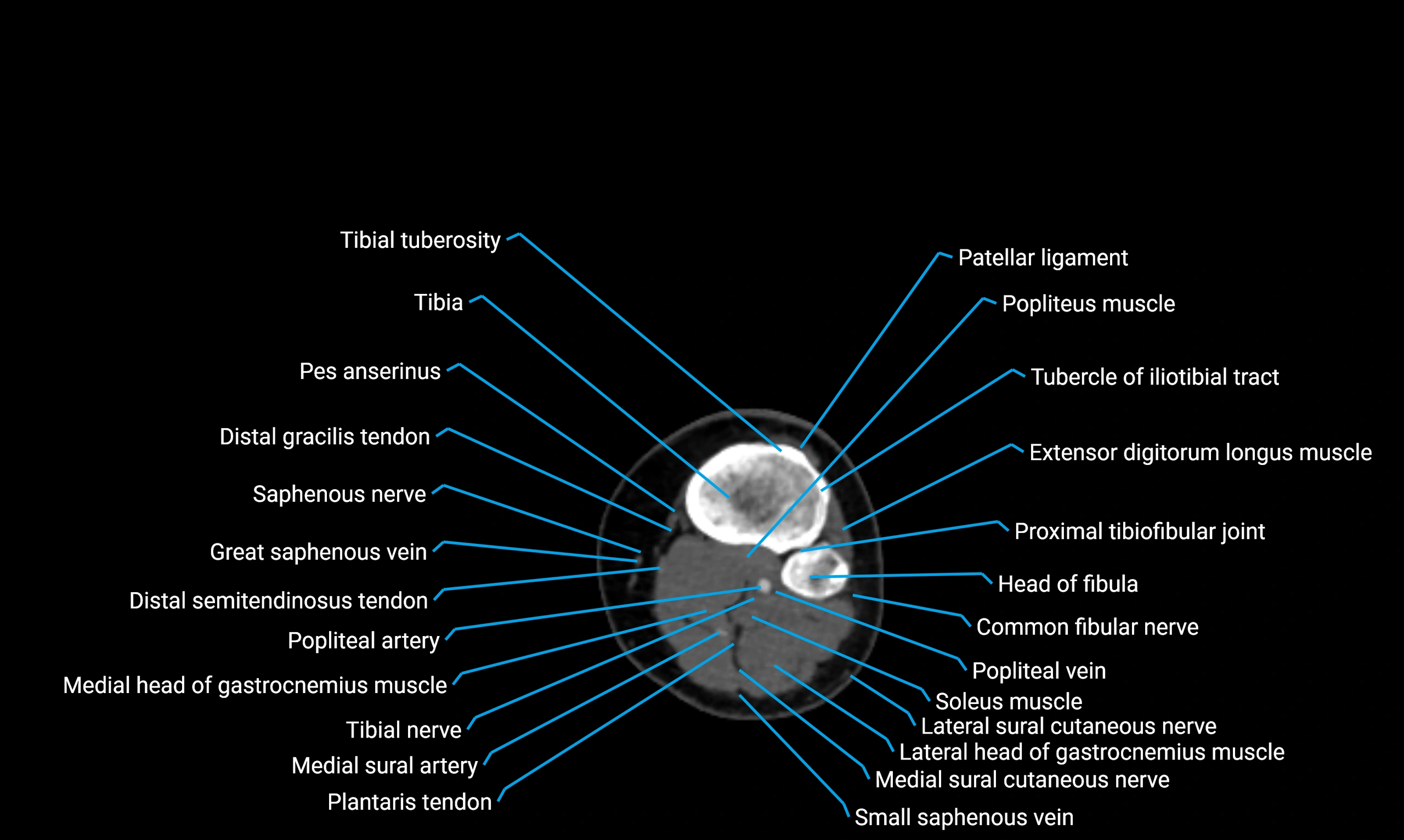 CT Lower Limb Anatomy – Normal Labeled CT Axial, Coronal, Sagittal ...