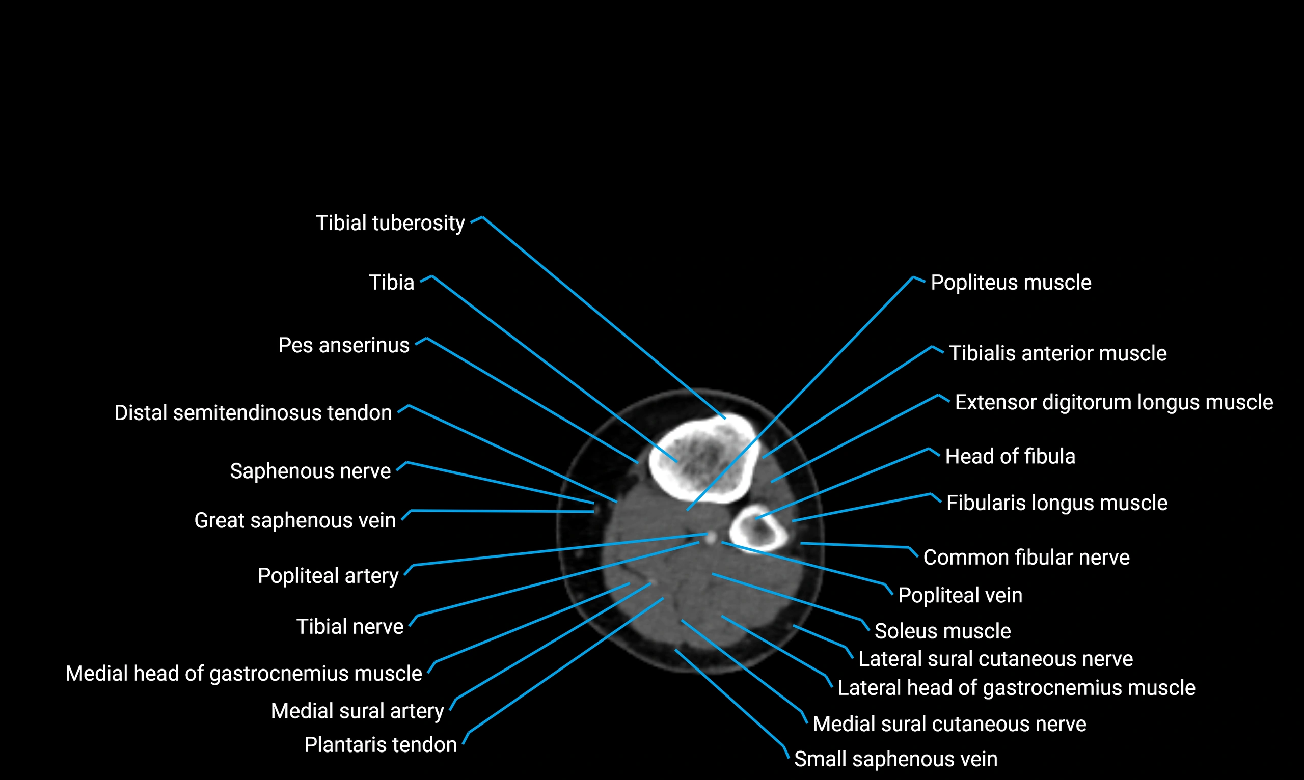 CT Lower Limb Anatomy – Normal Labeled CT Axial, Coronal, Sagittal ...