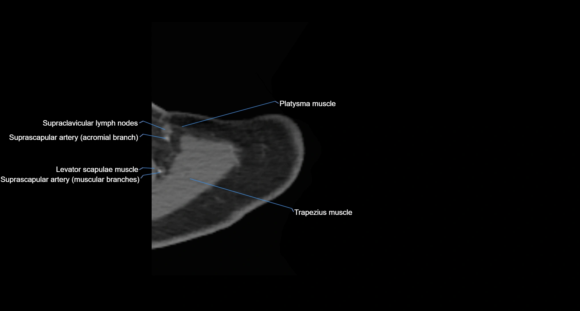 CT Shoulder Anatomy – Labeled Axial, Coronal & Sagittal Views
