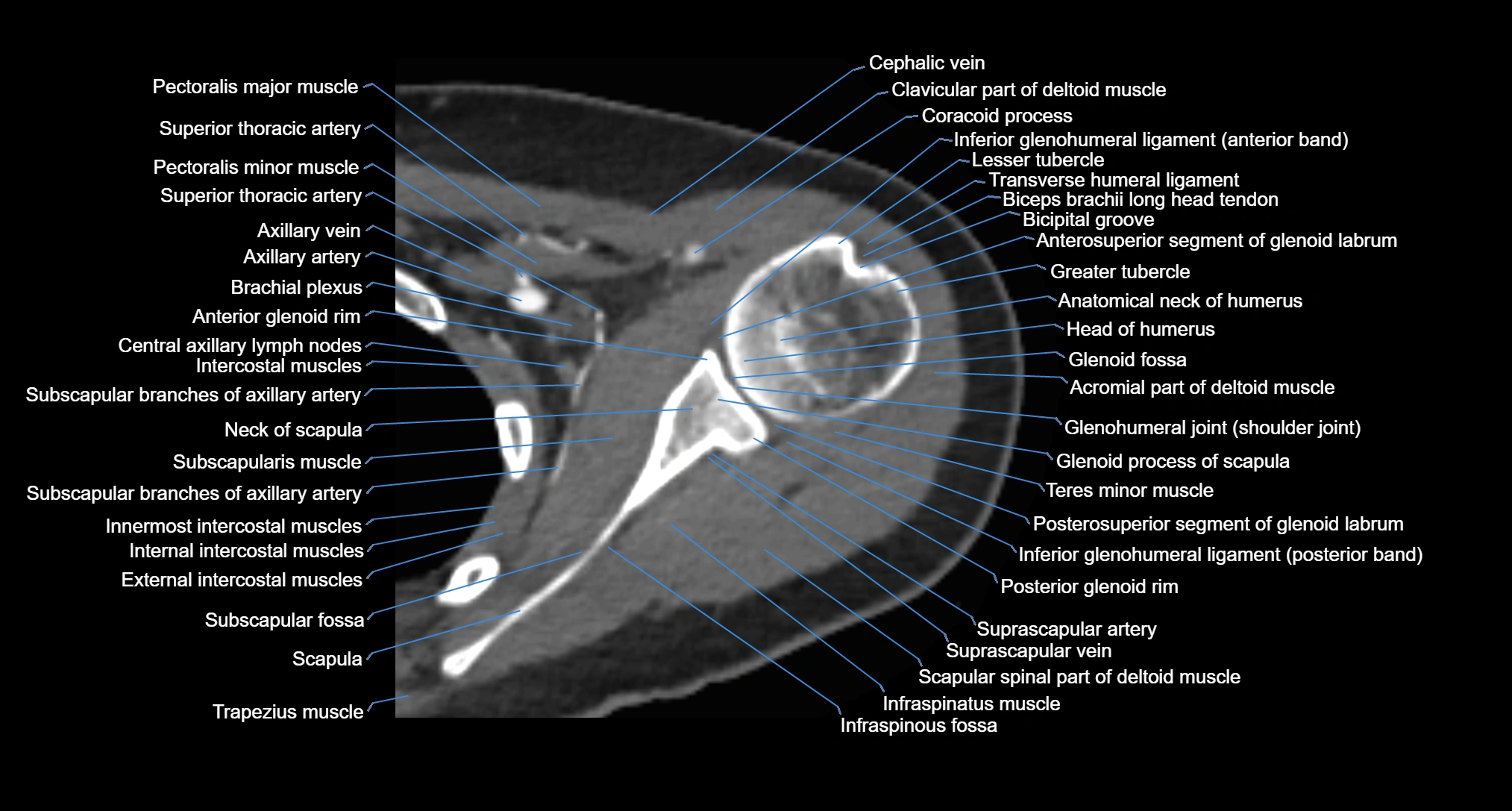 CT Shoulder Anatomy – Labeled Axial, Coronal & Sagittal Views