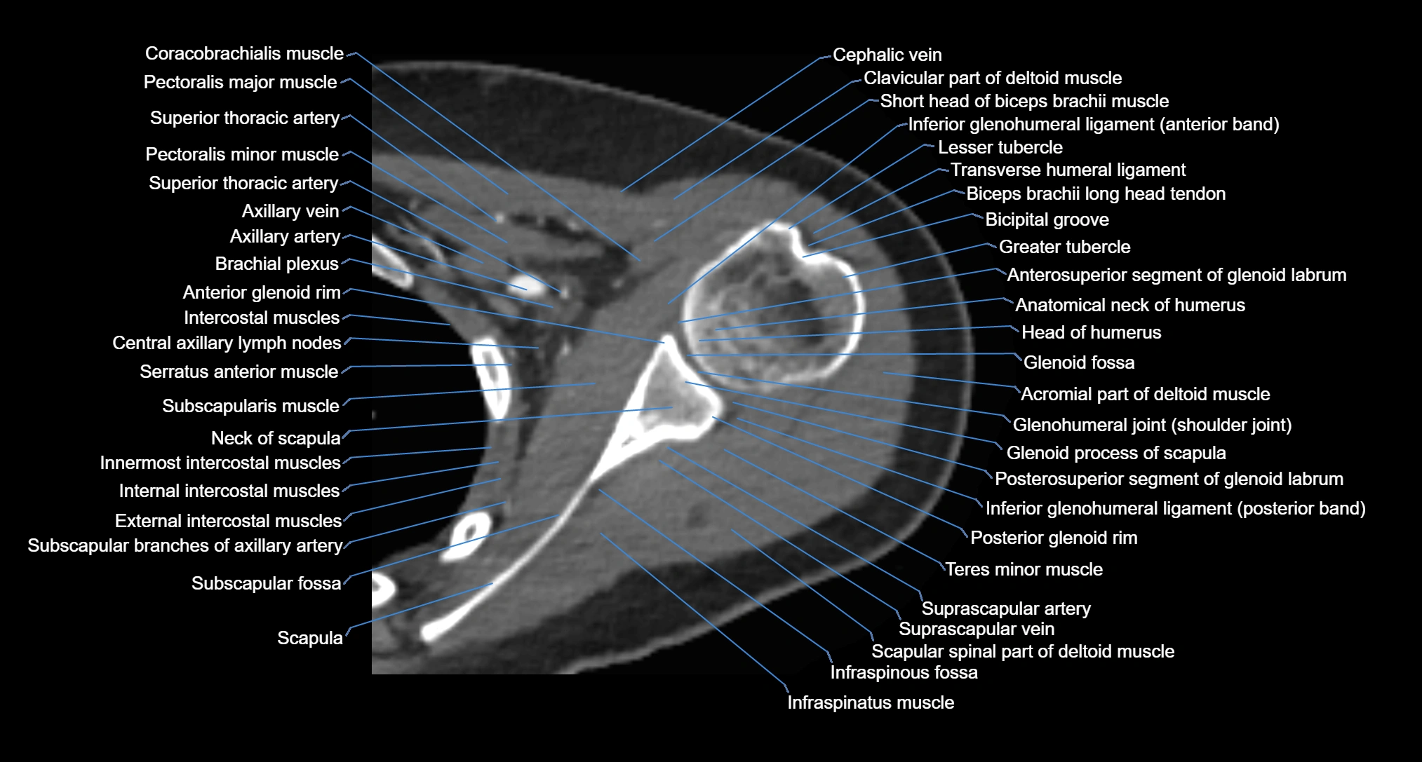 CT Shoulder Anatomy – Labeled Axial, Coronal & Sagittal Views
