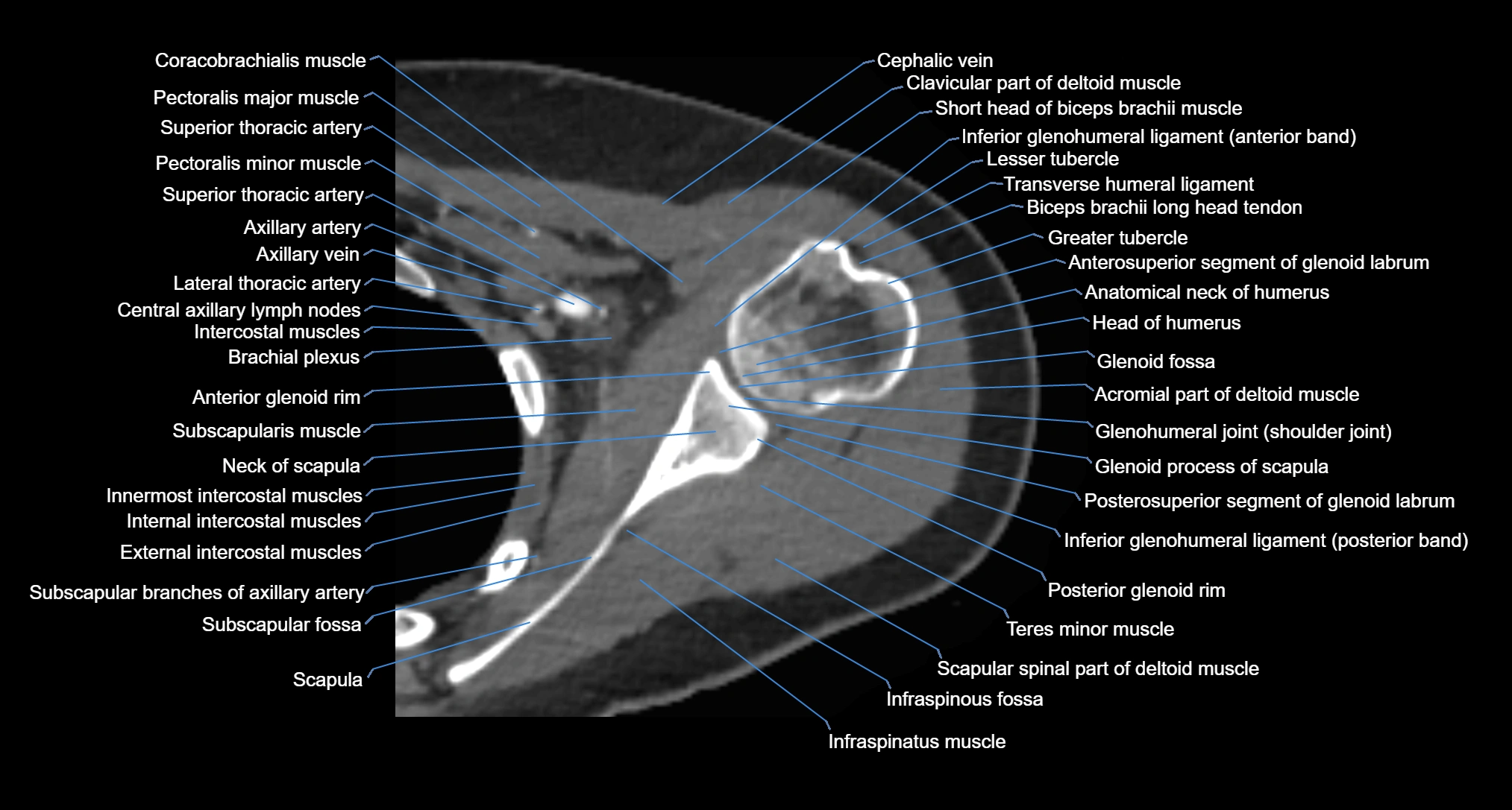 CT Shoulder Anatomy – Labeled Axial, Coronal & Sagittal Views