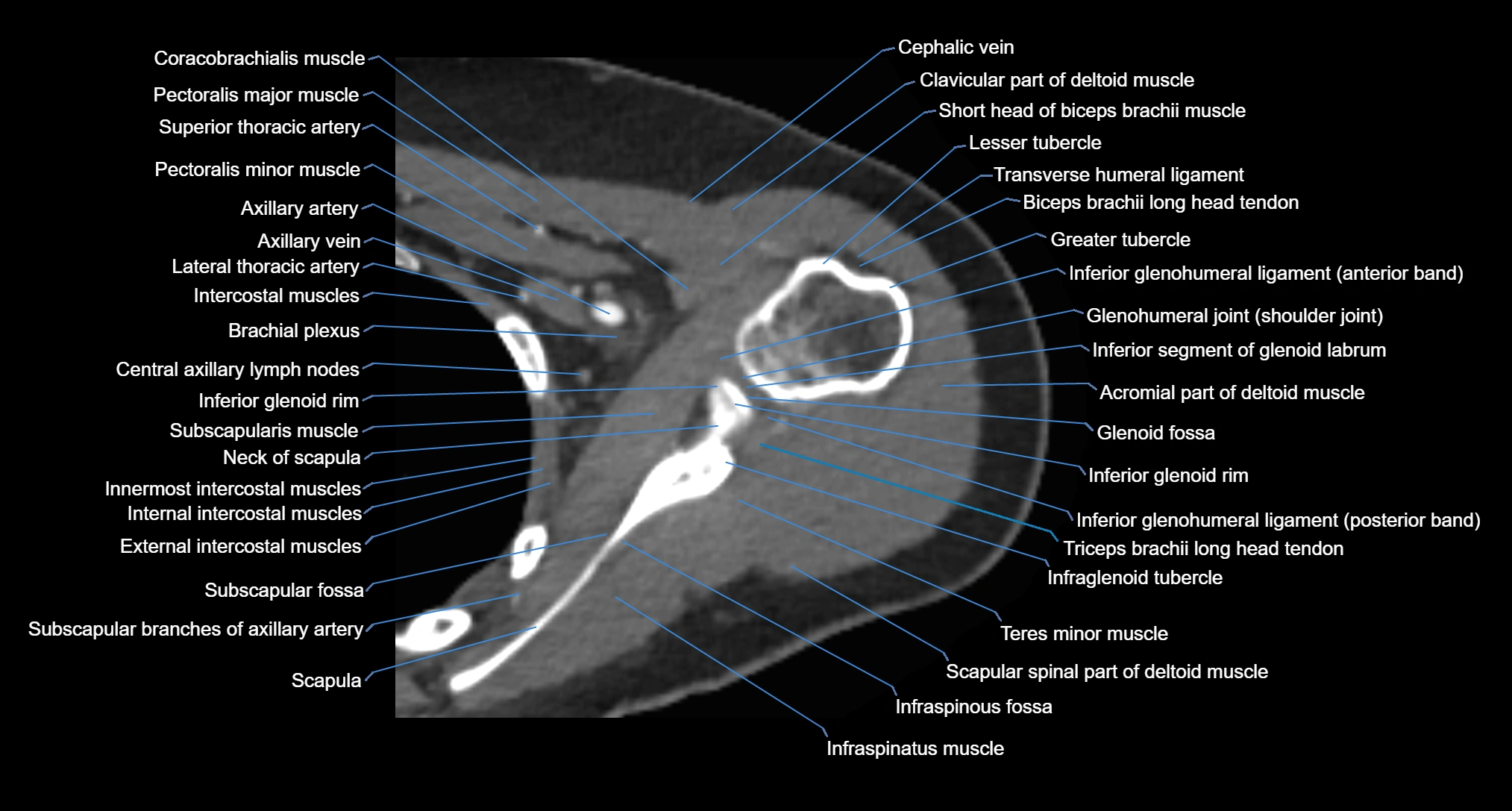 CT Shoulder Anatomy – Labeled Axial, Coronal & Sagittal Views
