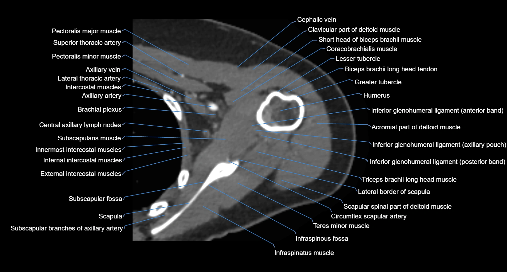 CT Shoulder Anatomy – Labeled Axial, Coronal & Sagittal Views