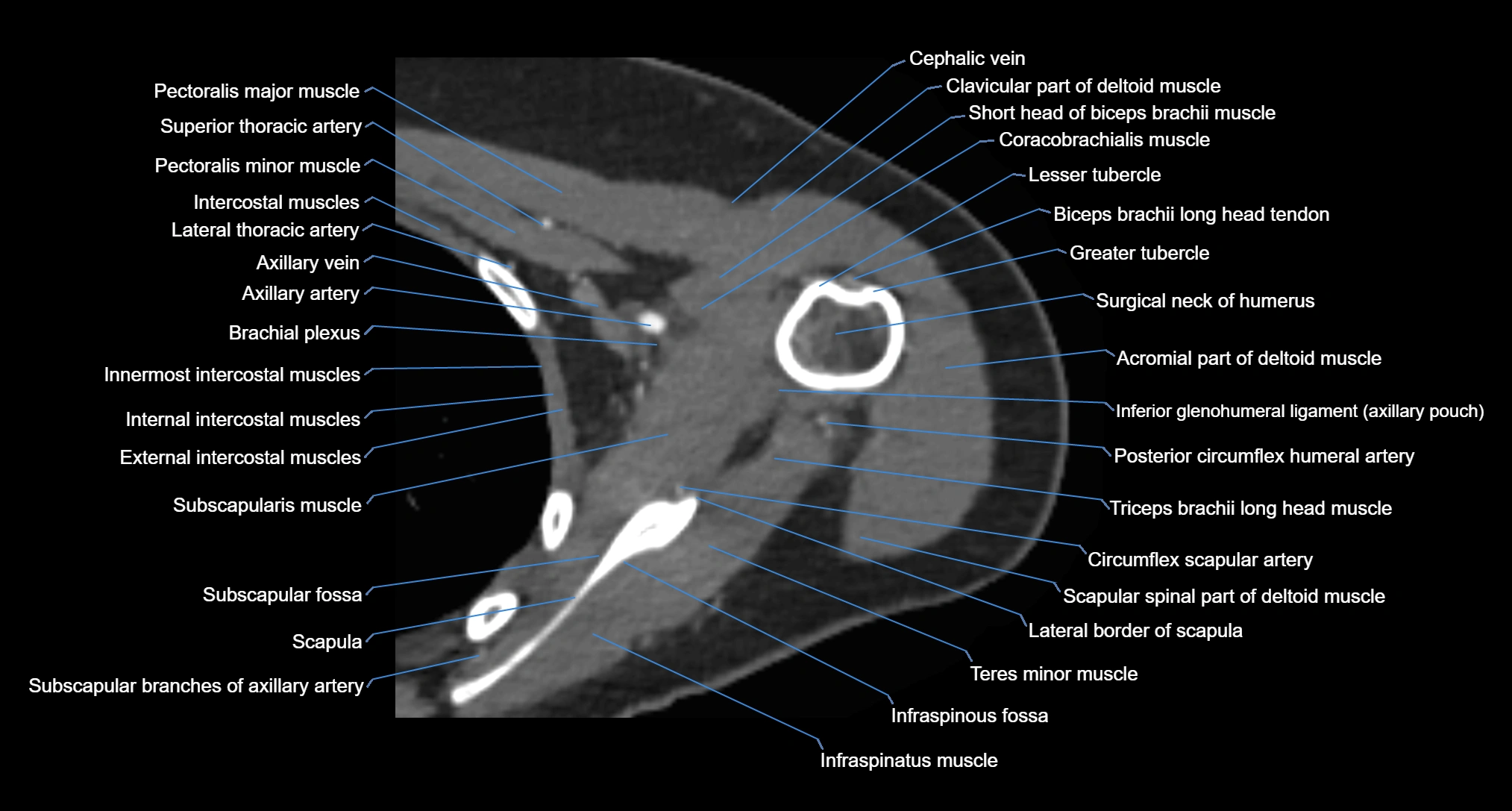 CT Shoulder Anatomy – Labeled Axial, Coronal & Sagittal Views