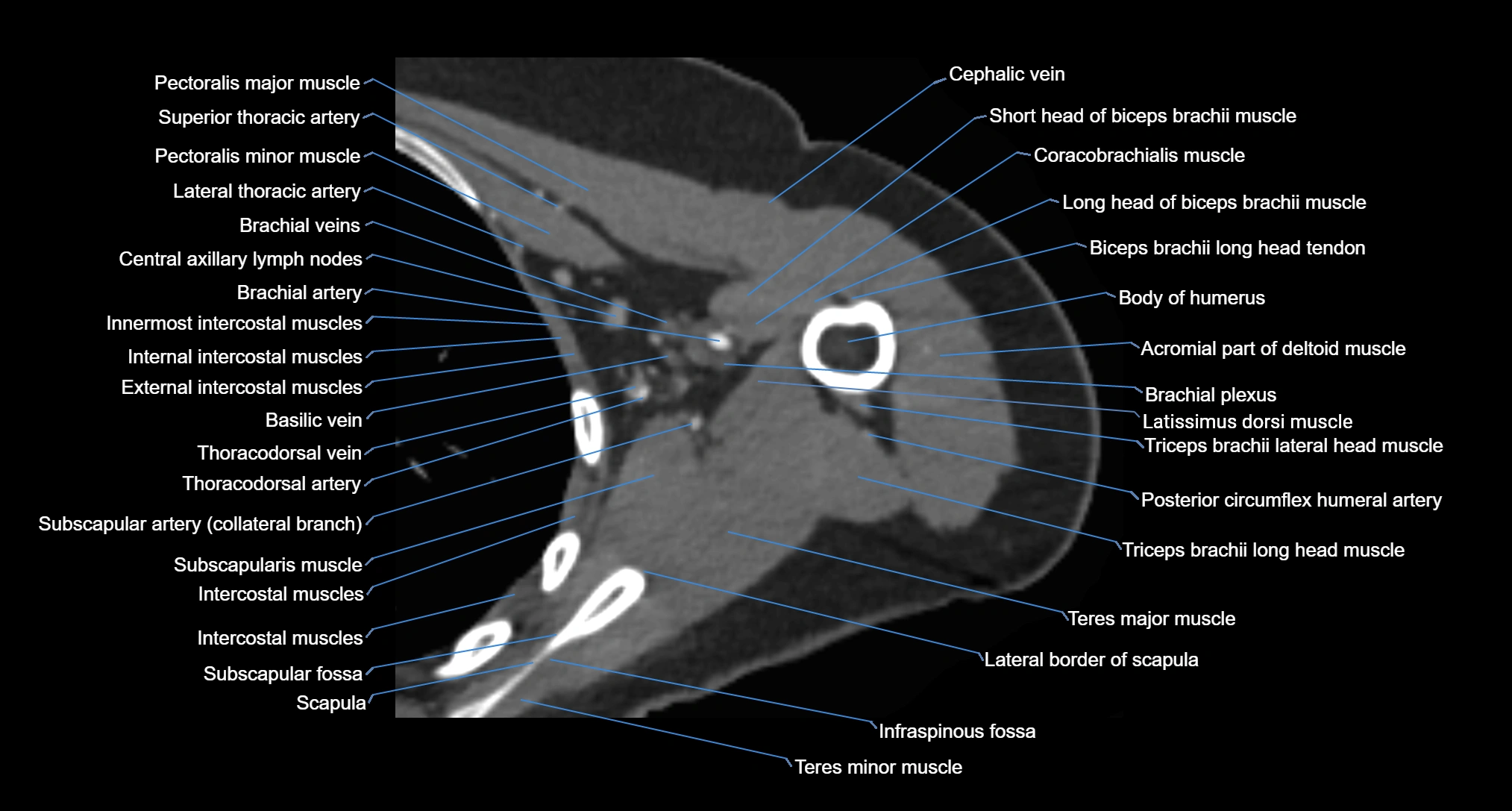 CT Shoulder Anatomy – Labeled Axial, Coronal & Sagittal Views