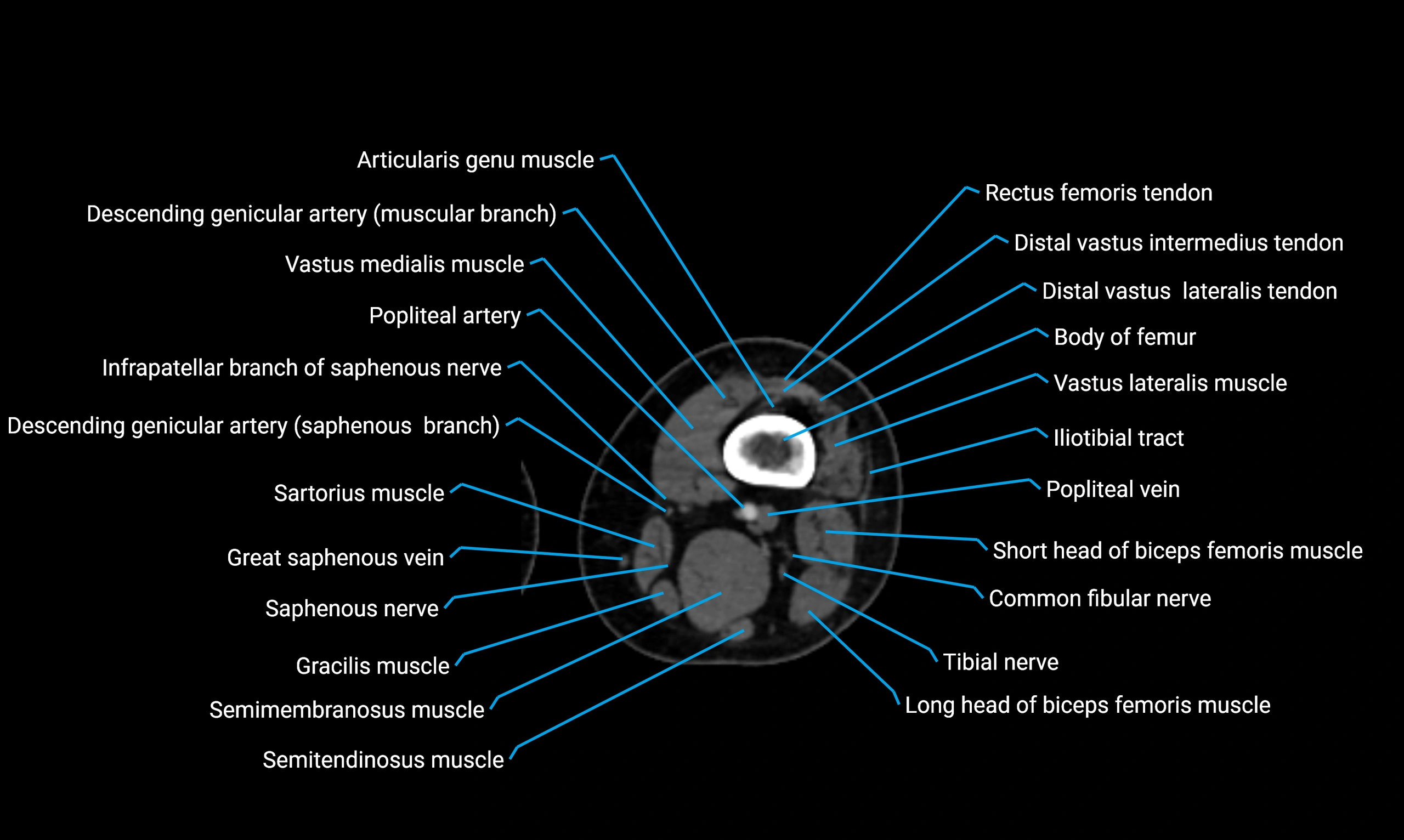 CT Thigh Anatomy – Labeled Axial, Coronal & Sagittal Cross-Sections