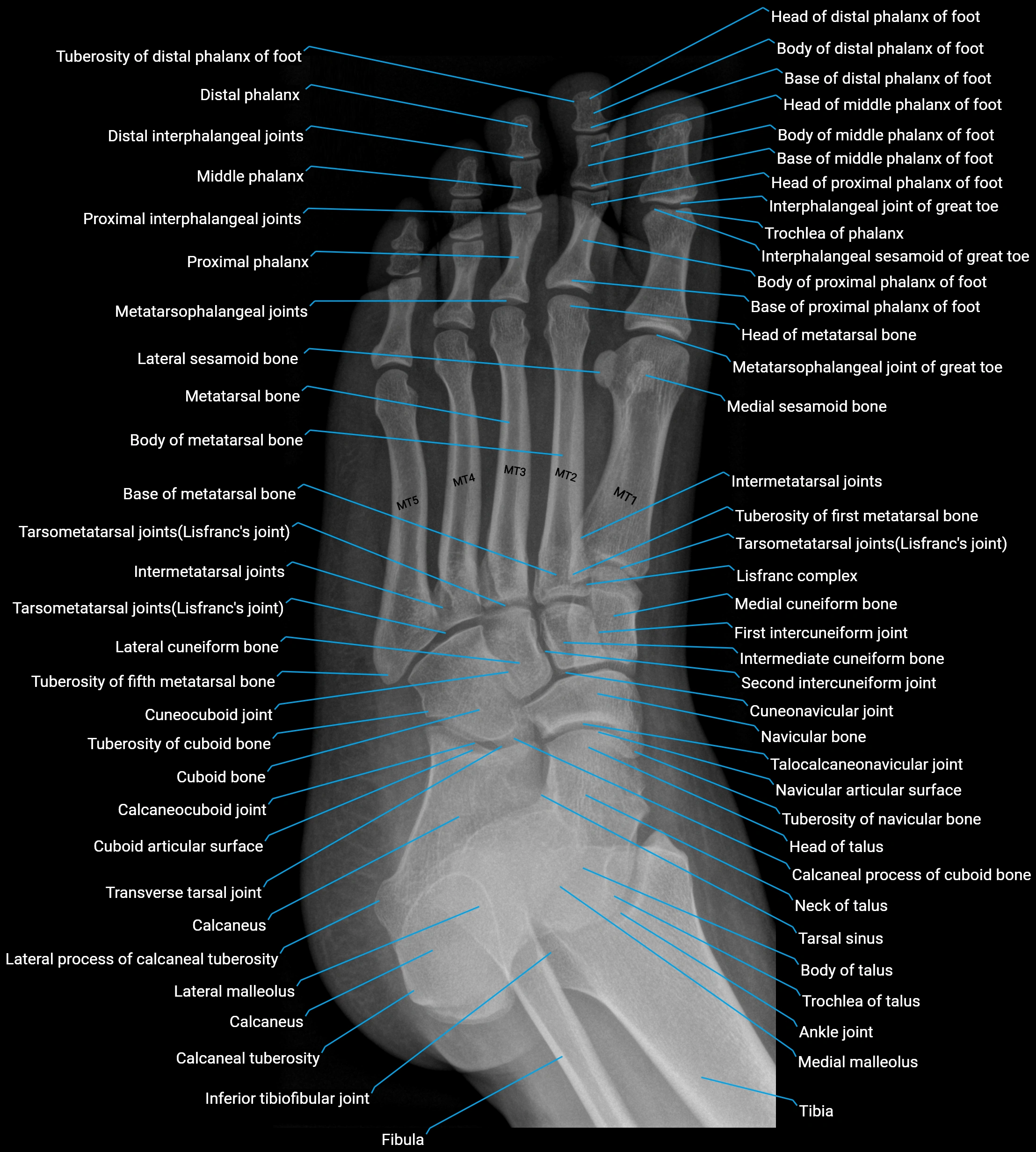 Foot X-Ray Anatomy – AP, Lateral & Oblique Views (Labeled Images)