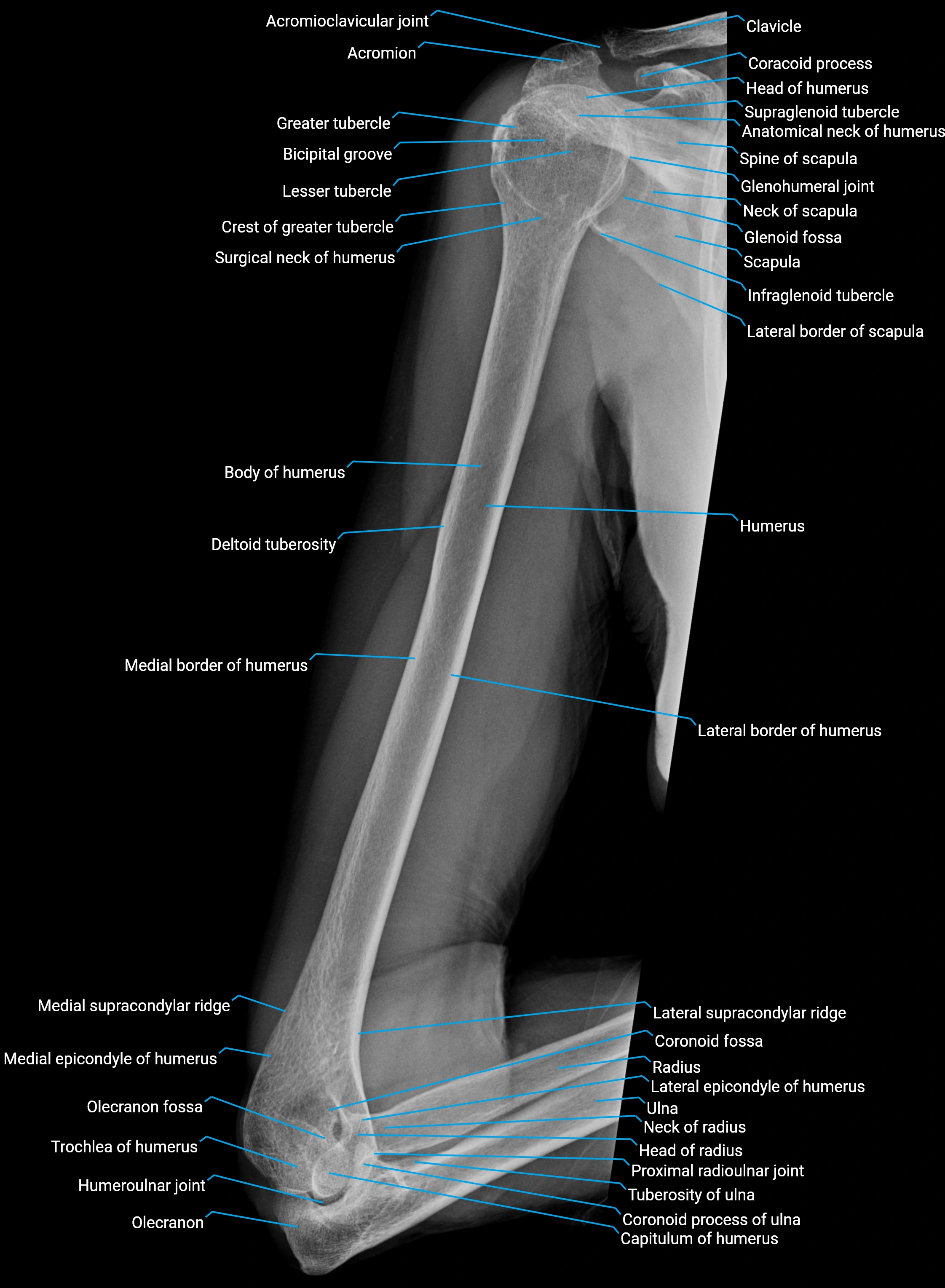 Normal Humerus X-Ray Anatomy – AP & Lateral Views with Labels