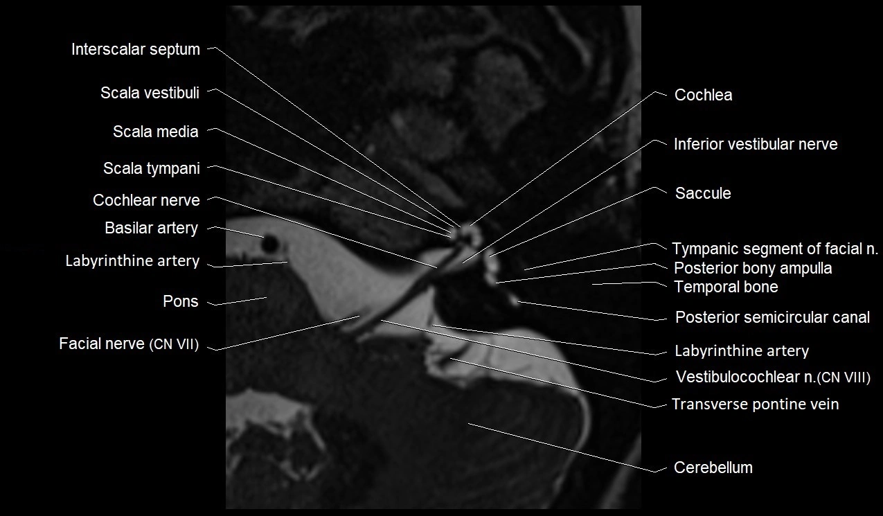 MRI Internal Auditory Canal (IAC/IAM) Anatomy – Labeled Axial, Sagittal ...