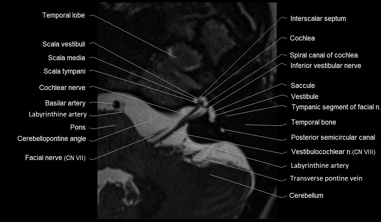 MRI Internal Auditory Canal (IAC/IAM) Anatomy – Labeled Axial, Sagittal ...