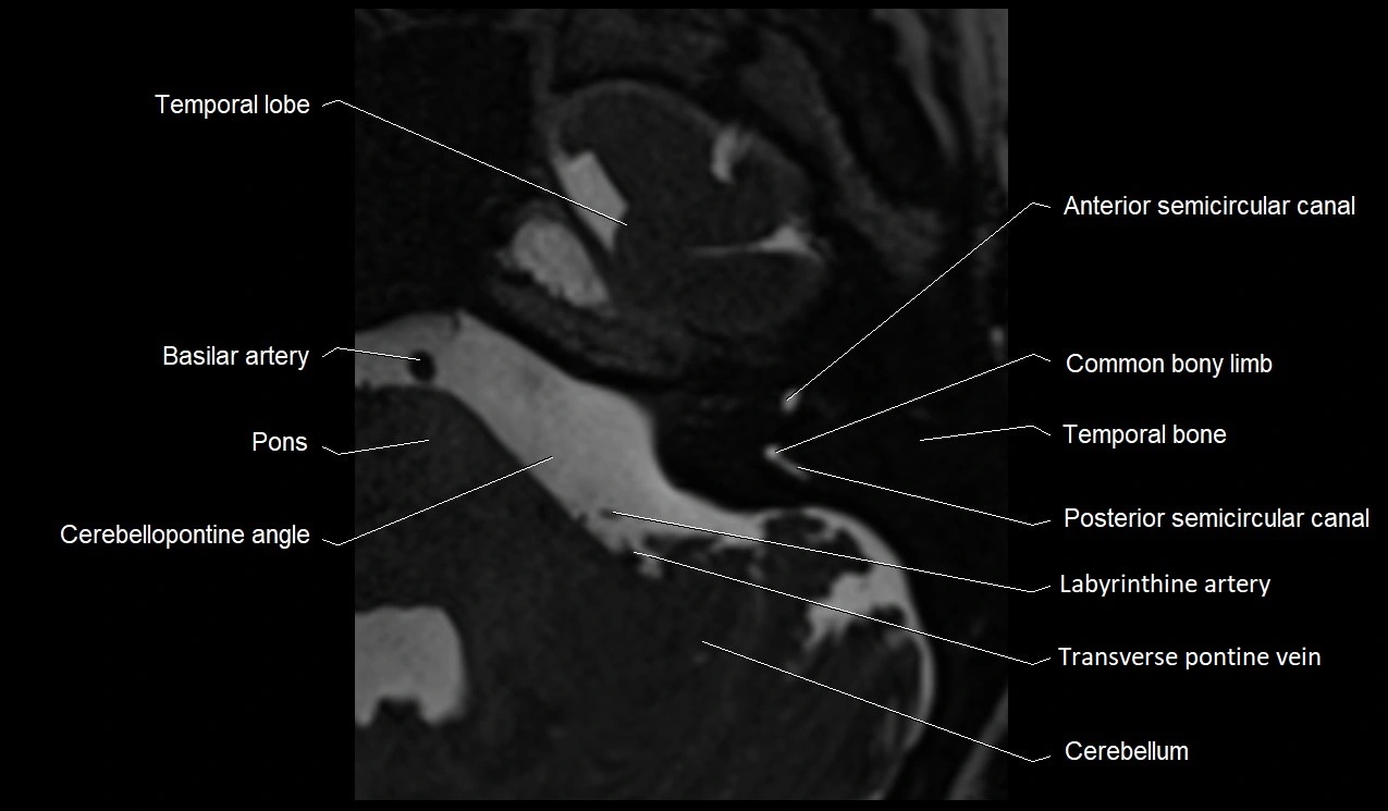 MRI Internal Auditory Canal (IAC/IAM) Anatomy – Labeled Axial, Sagittal ...