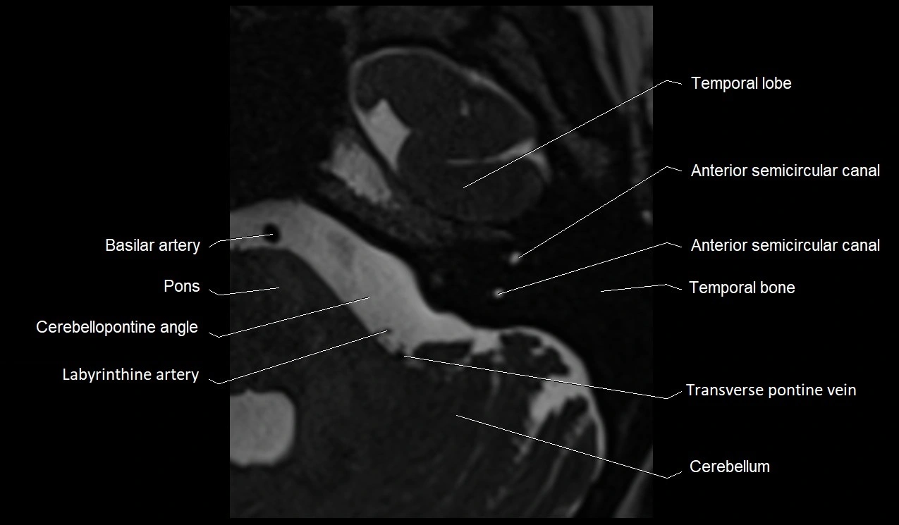 MRI Internal Auditory Canal (IAC/IAM) Anatomy – Labeled Axial, Sagittal ...