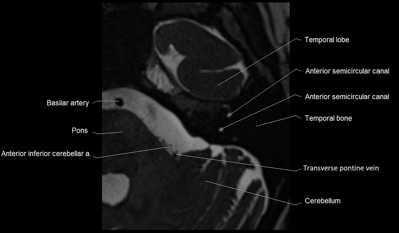 MRI Internal Auditory Canal (IAC/IAM) Anatomy – Labeled Axial, Sagittal ...