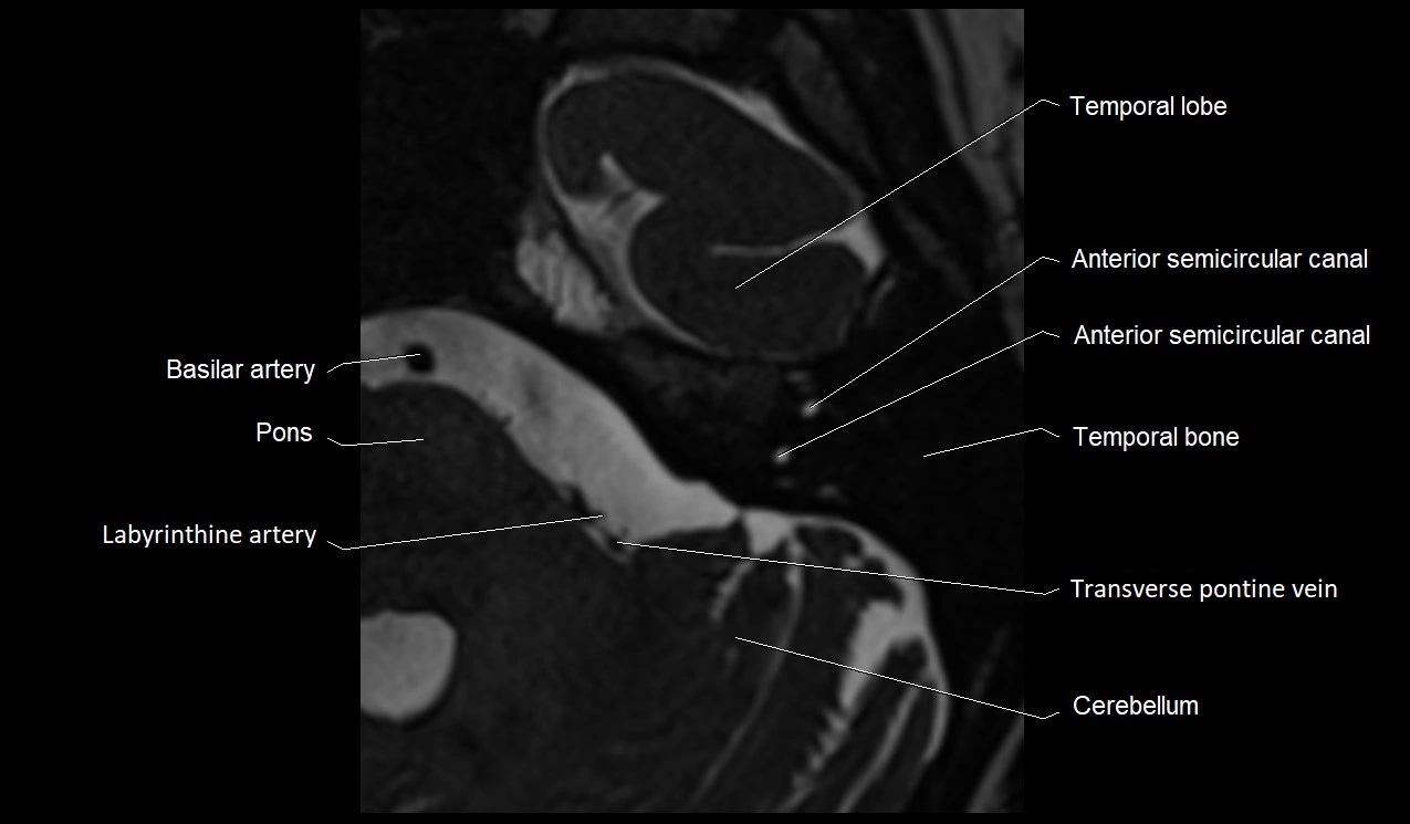 MRI Internal Auditory Canal (IAC/IAM) Anatomy – Labeled Axial, Sagittal ...