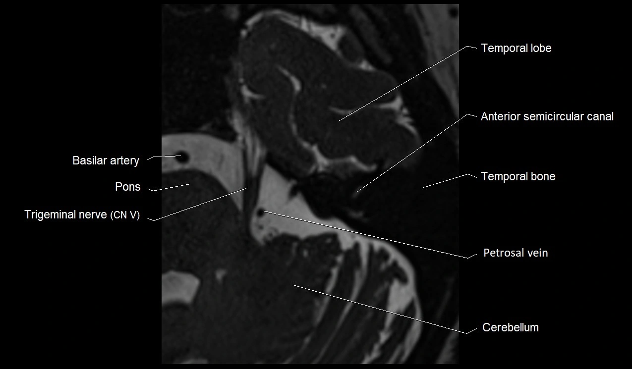 MRI Internal Auditory Canal (IAC/IAM) Anatomy – Labeled Axial, Sagittal ...