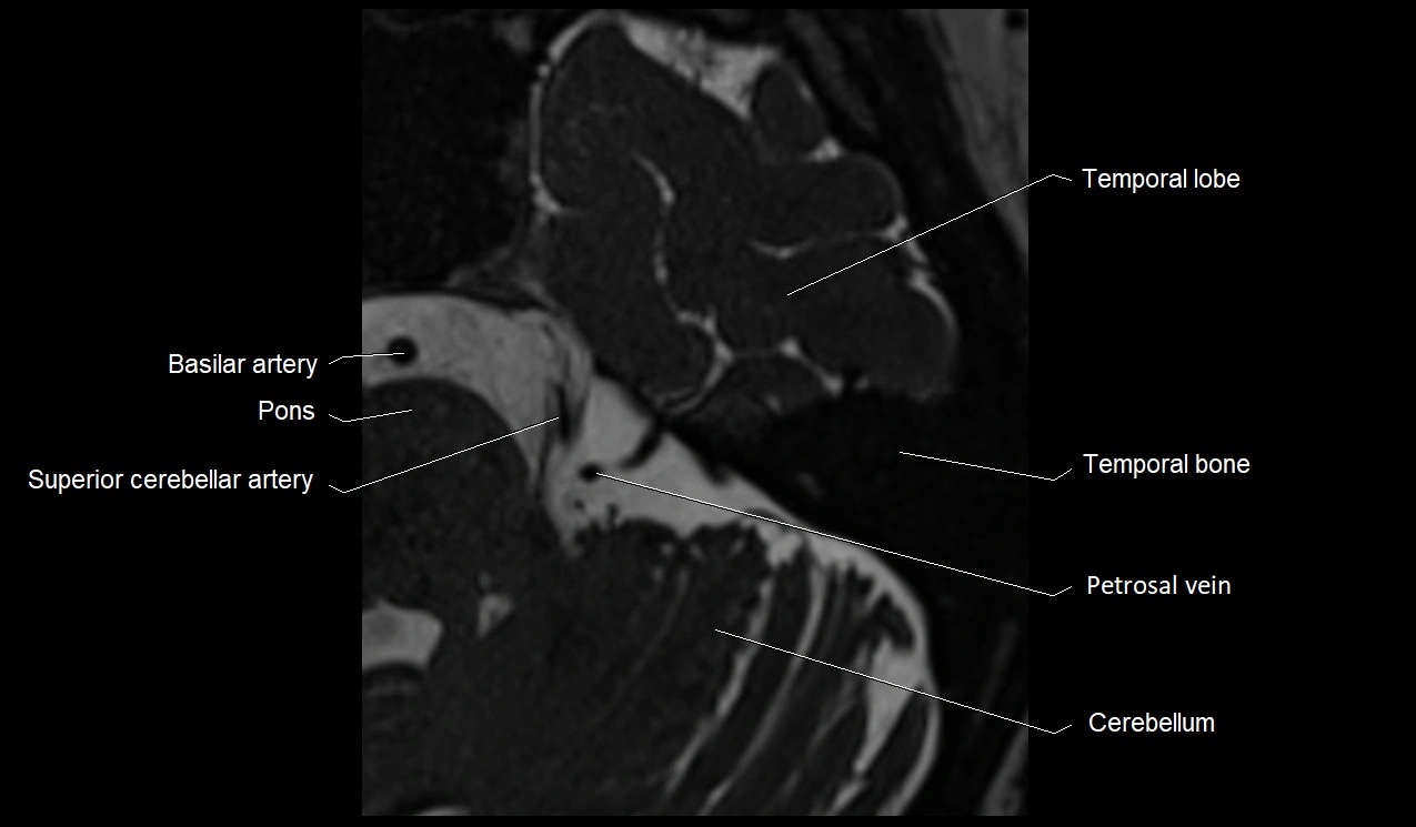 MRI Internal Auditory Canal (IAC/IAM) Anatomy – Labeled Axial, Sagittal ...