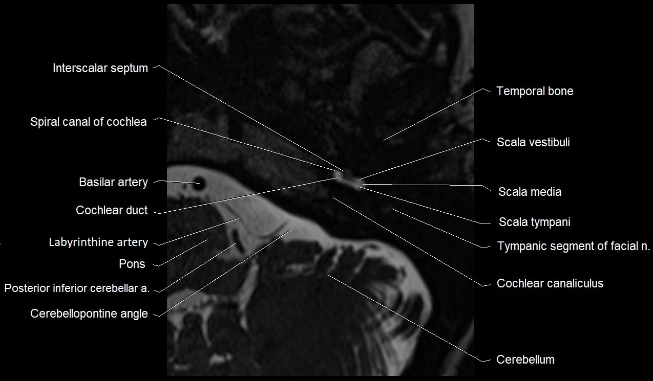 MRI Internal Auditory Canal (IAC/IAM) Anatomy – Labeled Axial, Sagittal ...