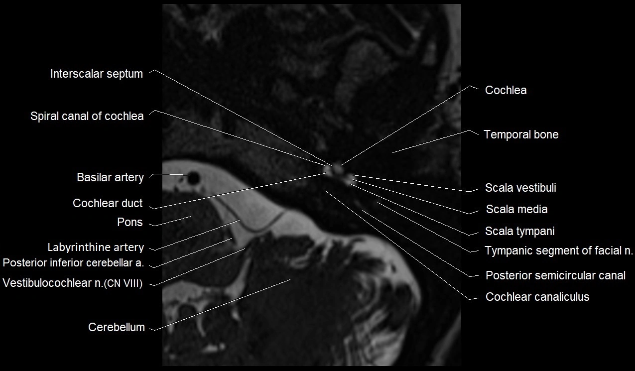 MRI Internal Auditory Canal (IAC/IAM) Anatomy – Labeled Axial, Sagittal ...