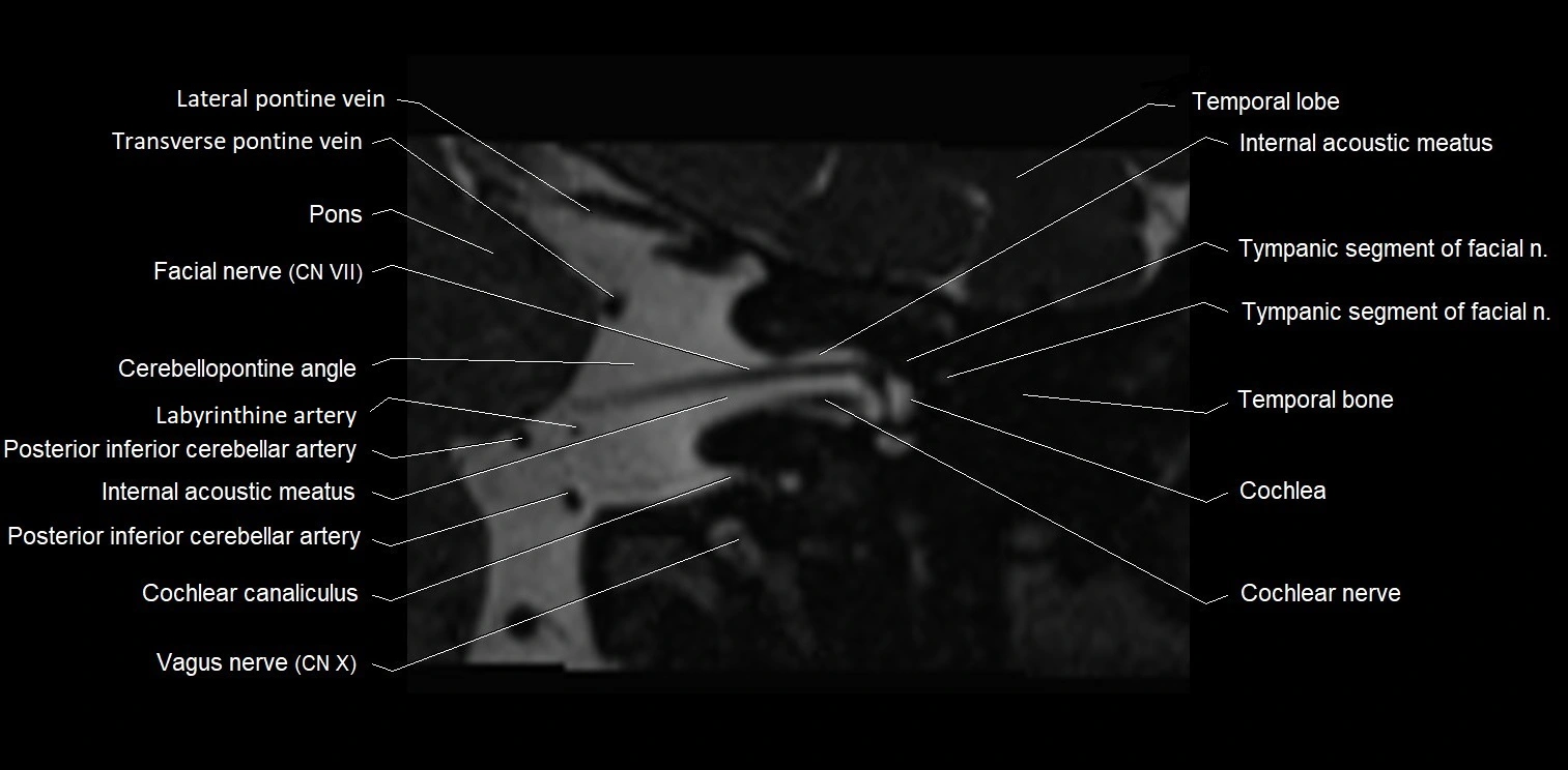 MRI Internal Auditory Canal (IAC/IAM) Anatomy – Labeled Axial, Sagittal ...