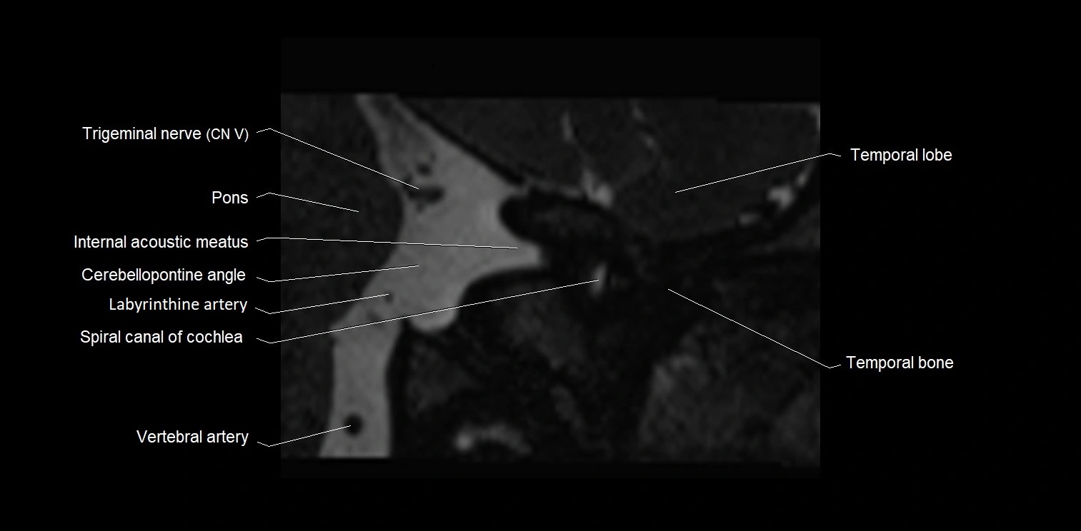 MRI Internal Auditory Canal (IAC/IAM) Anatomy – Labeled Axial, Sagittal ...