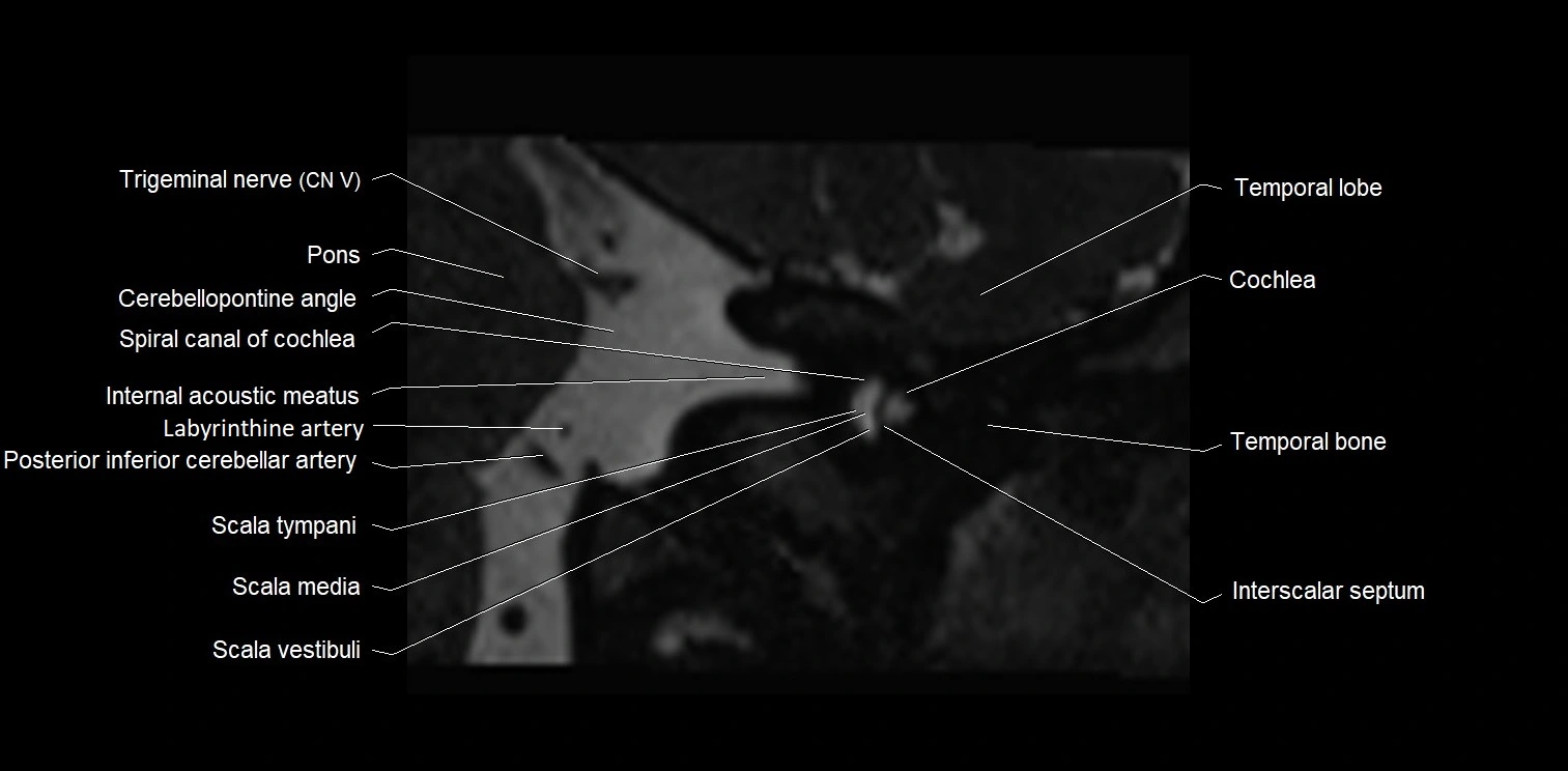 MRI Internal Auditory Canal (IAC/IAM) Anatomy – Labeled Axial, Sagittal ...