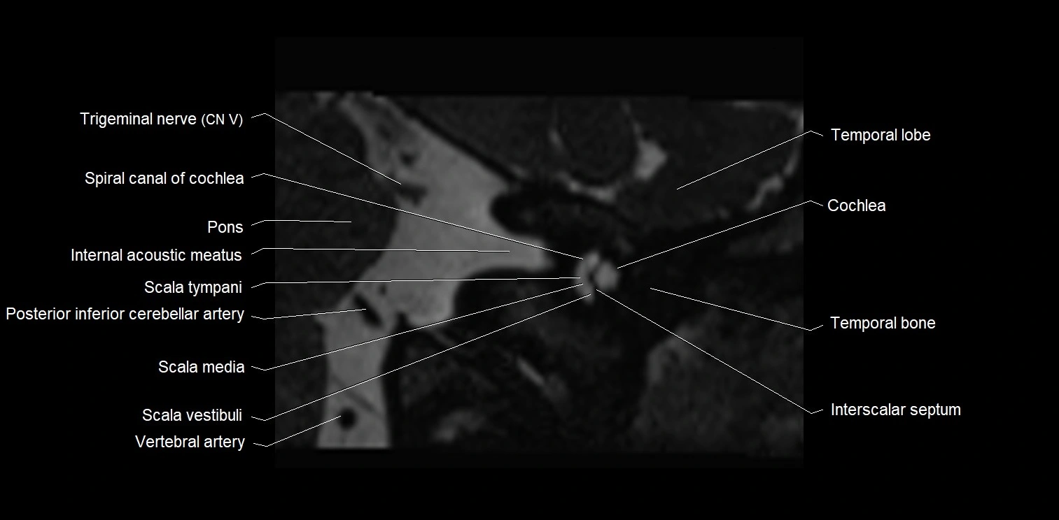MRI Internal Auditory Canal (IAC/IAM) Anatomy – Labeled Axial, Sagittal ...