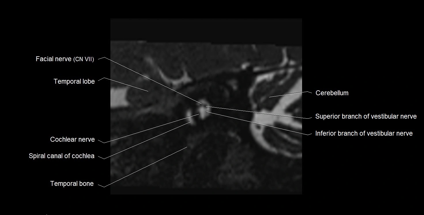 MRI Internal Auditory Canal (IAC/IAM) Anatomy – Labeled Axial, Sagittal ...