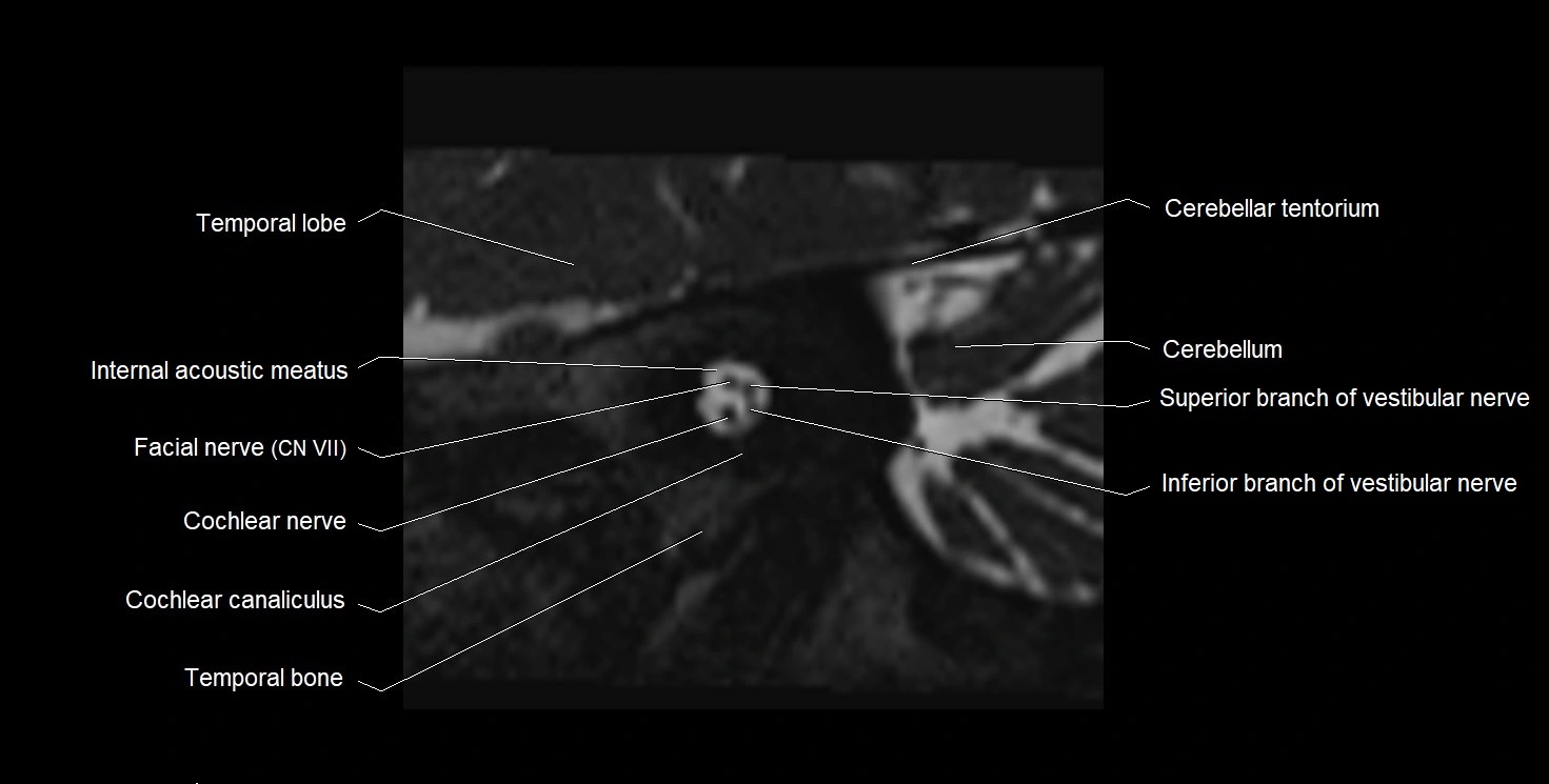 MRI Internal Auditory Canal (IAC/IAM) Anatomy – Labeled Axial, Sagittal ...