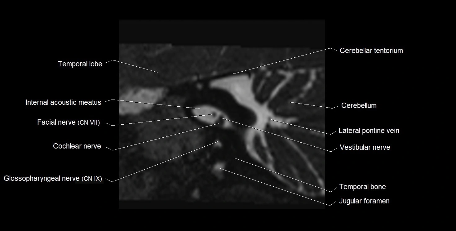 MRI Internal Auditory Canal (IAC/IAM) Anatomy – Labeled Axial, Sagittal ...
