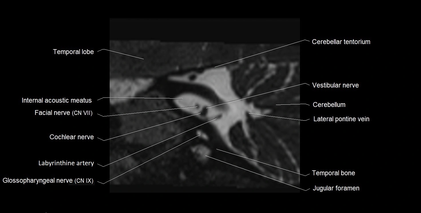 MRI Internal Auditory Canal (IAC/IAM) Anatomy – Labeled Axial, Sagittal ...