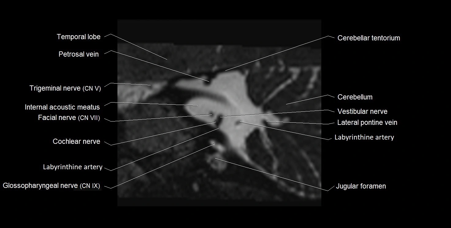 MRI Internal Auditory Canal (IAC/IAM) Anatomy – Labeled Axial, Sagittal ...