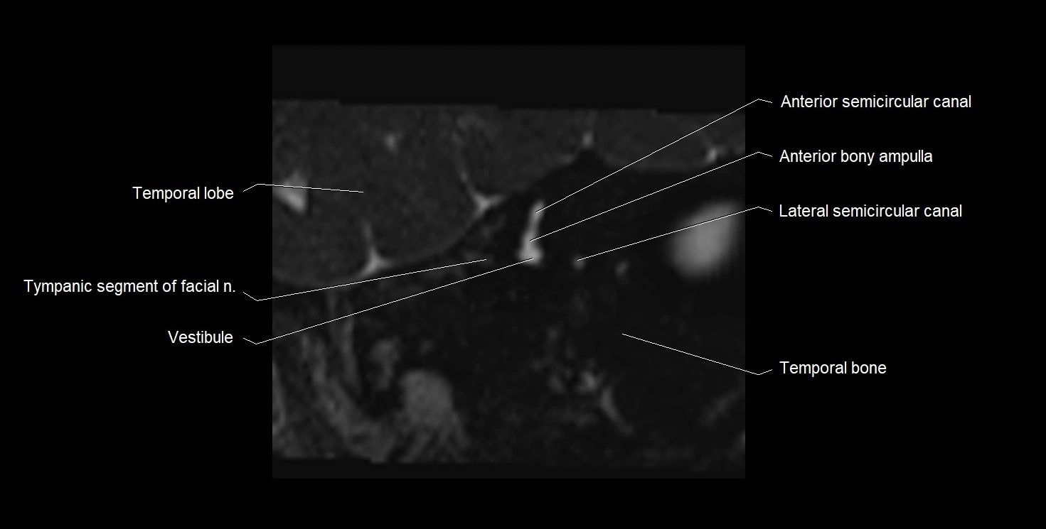 MRI Internal Auditory Canal (IAC/IAM) Anatomy – Labeled Axial, Sagittal ...