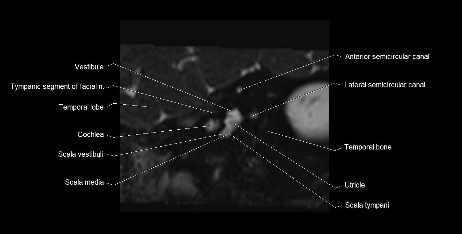 MRI Internal Auditory Canal (IAC/IAM) Anatomy – Labeled Axial, Sagittal ...