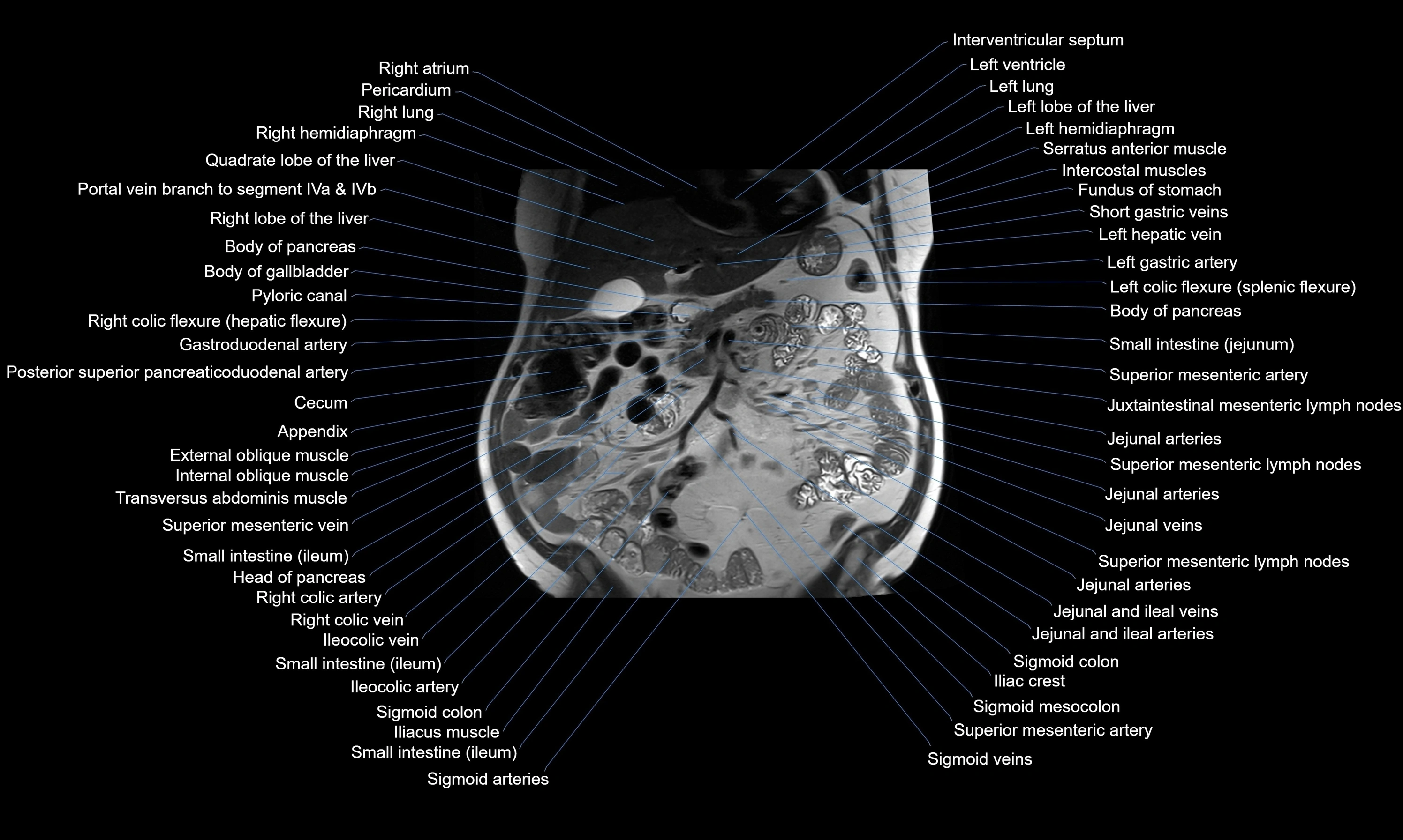 MRI Abdomen Anatomy – Labeled Axial, Coronal & Sagittal MRI Images