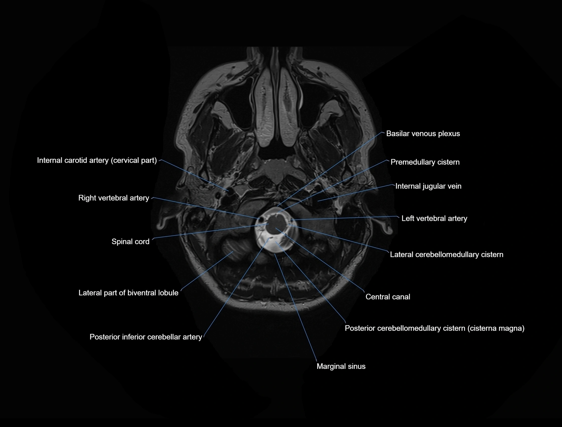 MRI-Brain-axial-cross-sectional-radiology-anatomy-3T-labelled-image-00003.webp