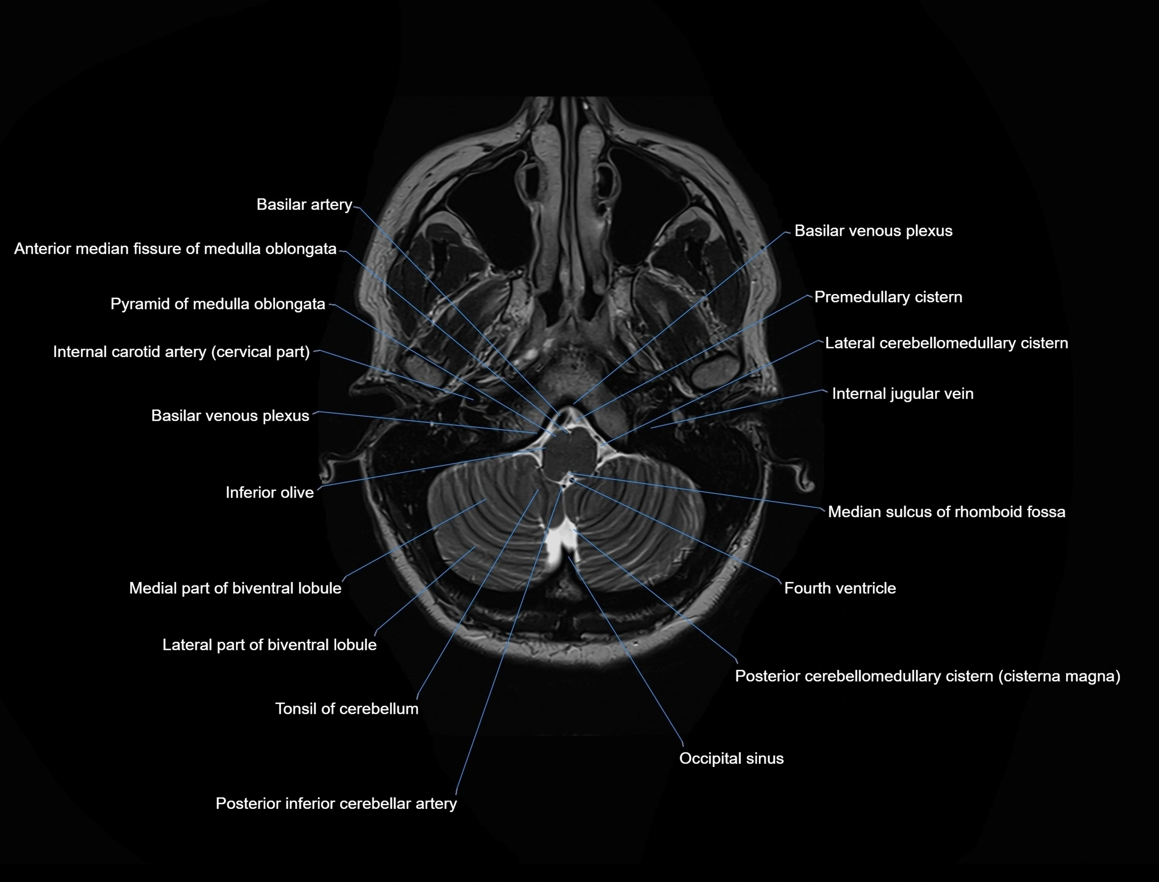 MRI-Brain-axial-cross-sectional-radiology-anatomy-3T-labelled-image-00007.webp