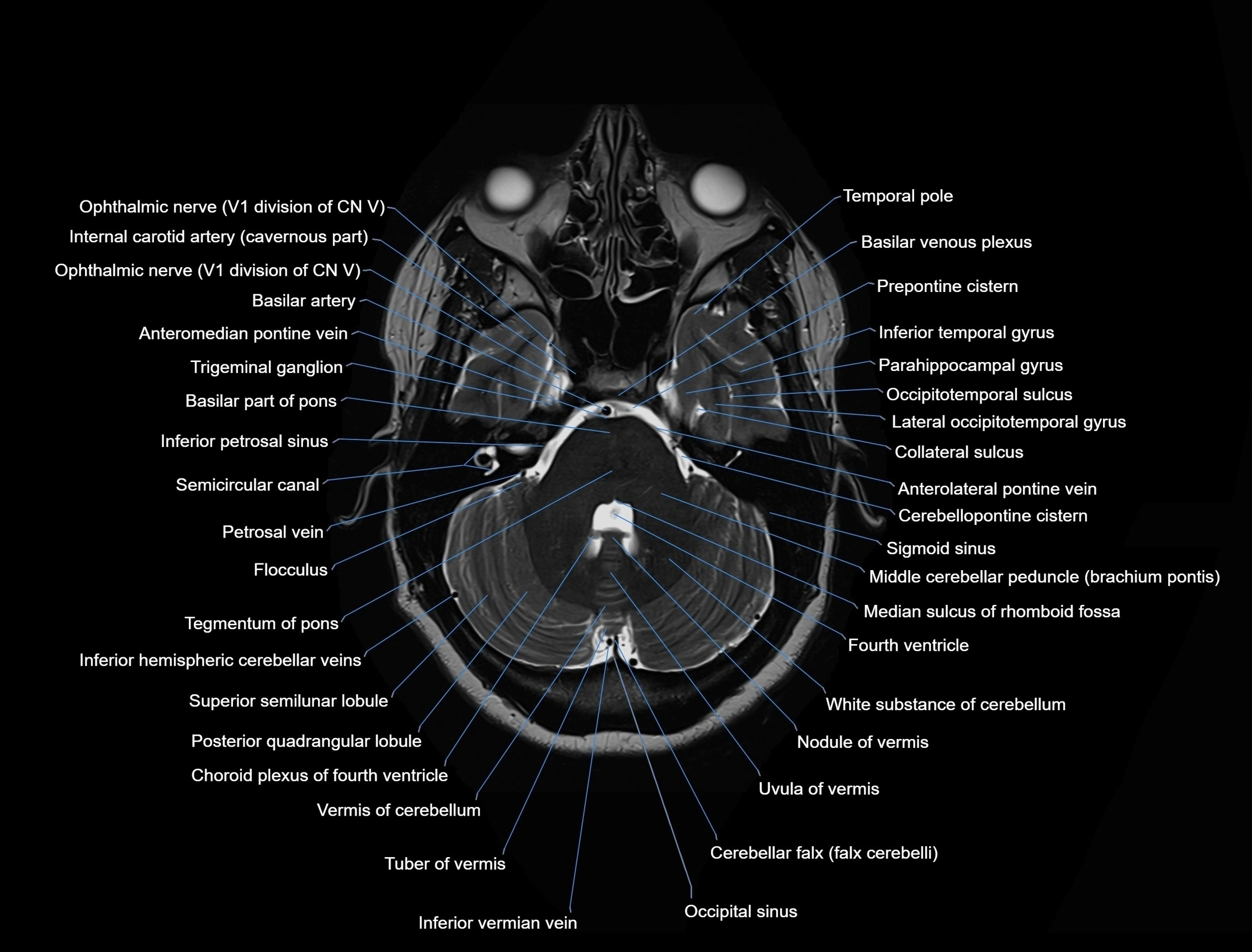 MRI-Brain-axial-cross-sectional-radiology-anatomy-3T-labelled-image-00015.webp