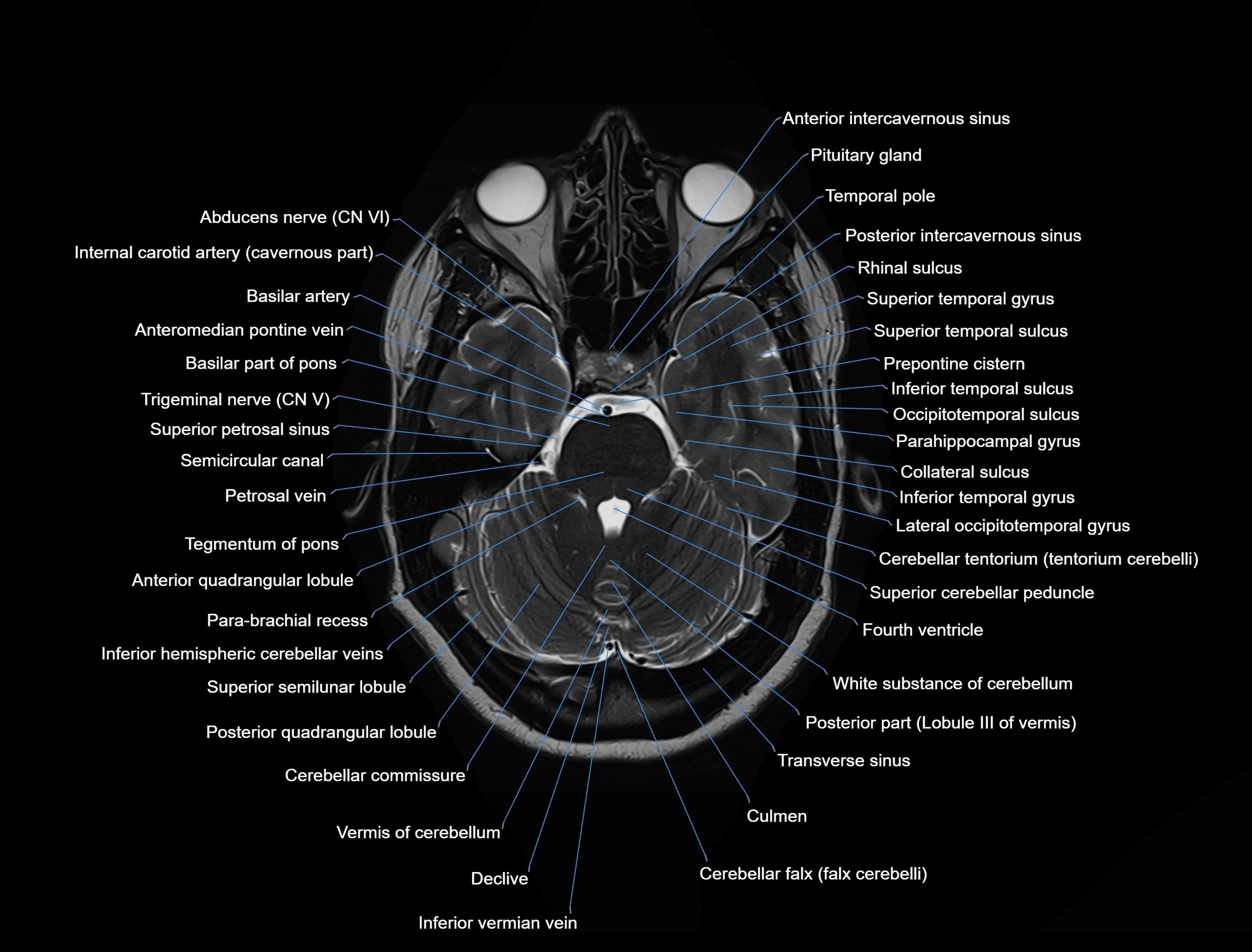 MRI-Brain-axial-cross-sectional-radiology-anatomy-3T-labelled-image-00017.webp