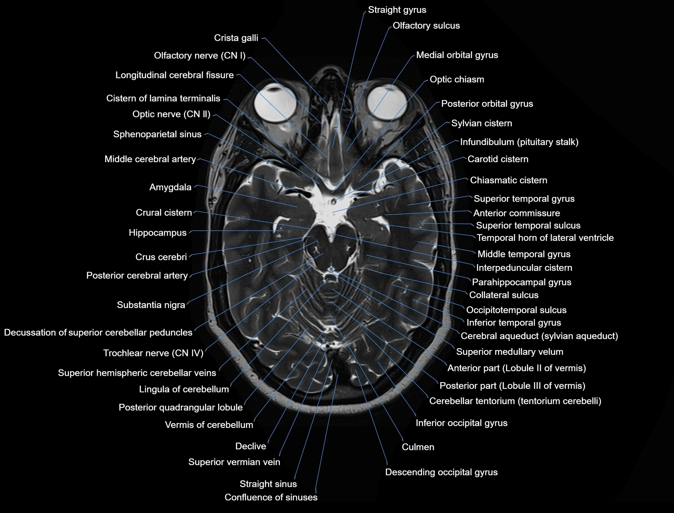 MRI-Brain-axial-cross-sectional-radiology-anatomy-3T-labelled-image-00021.webp