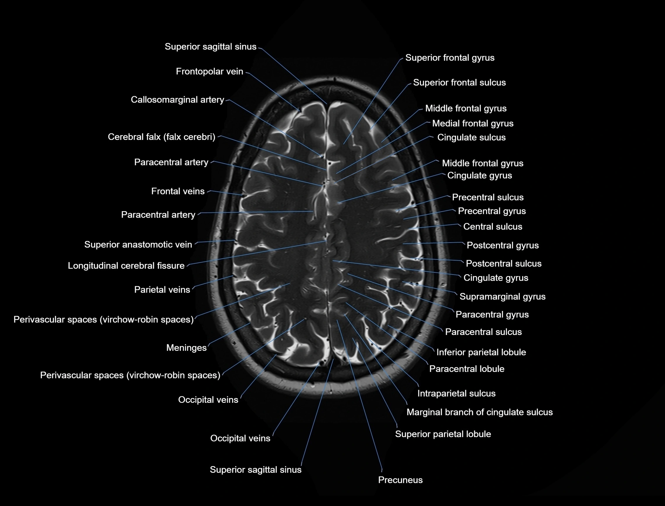 MRI-Brain-axial-cross-sectional-radiology-anatomy-3T-labelled-image-00044.webp
