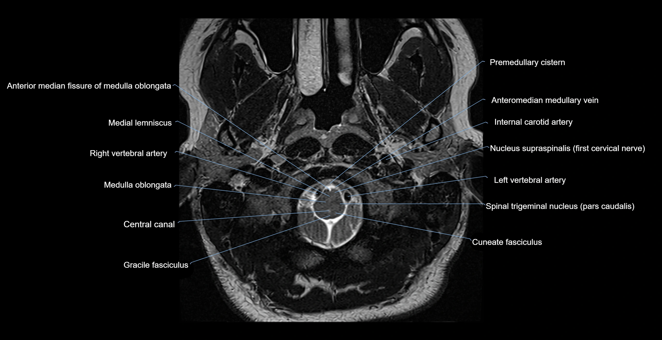 MRI-brainstem-&-basal-ganglia-anatomy-labelled-3T-MRI-images-00001.webp