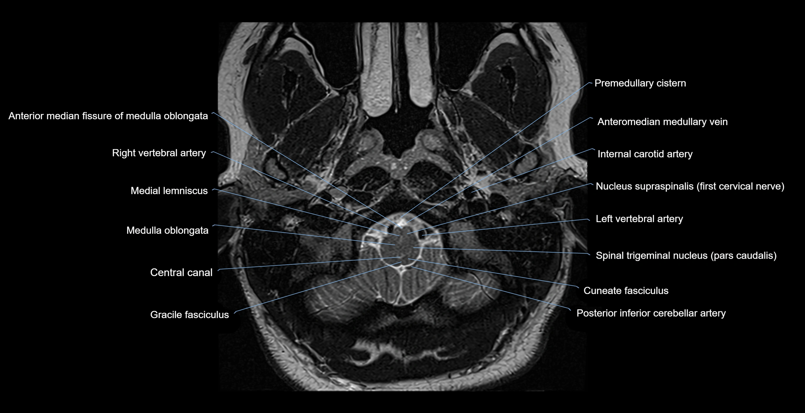 MRI-brainstem-&-basal-ganglia-anatomy-labelled-3T-MRI-images-00002.webp