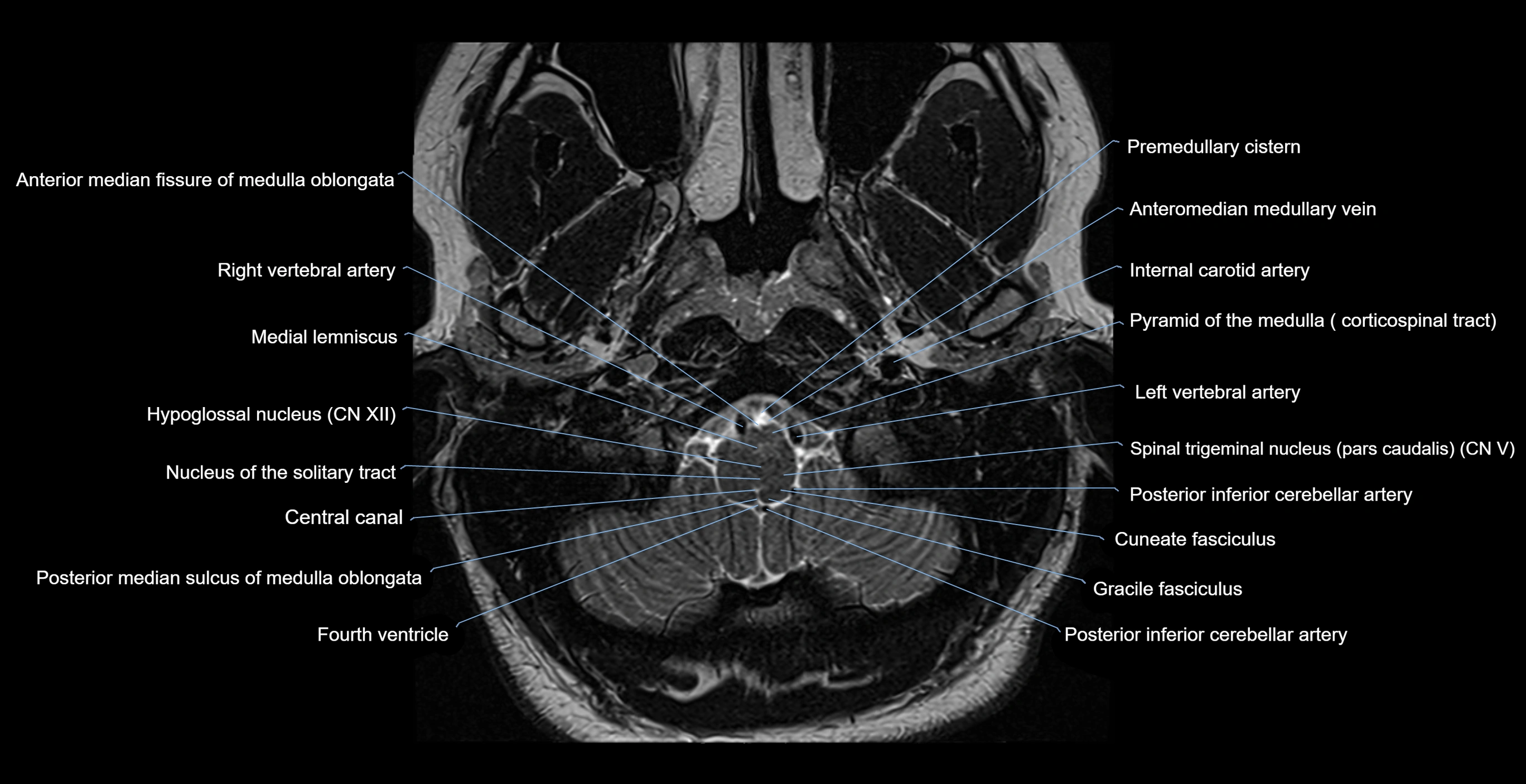 MRI-brainstem-&-basal-ganglia-anatomy-labelled-3T-MRI-images-00003.webp