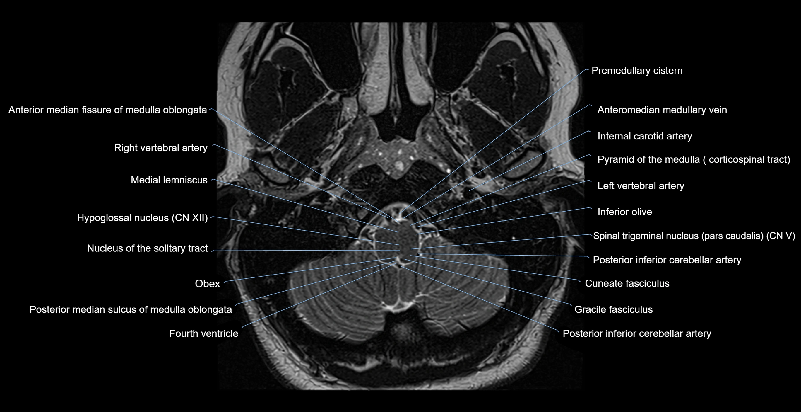 MRI-brainstem-&-basal-ganglia-anatomy-labelled-3T-MRI-images-00004.webp