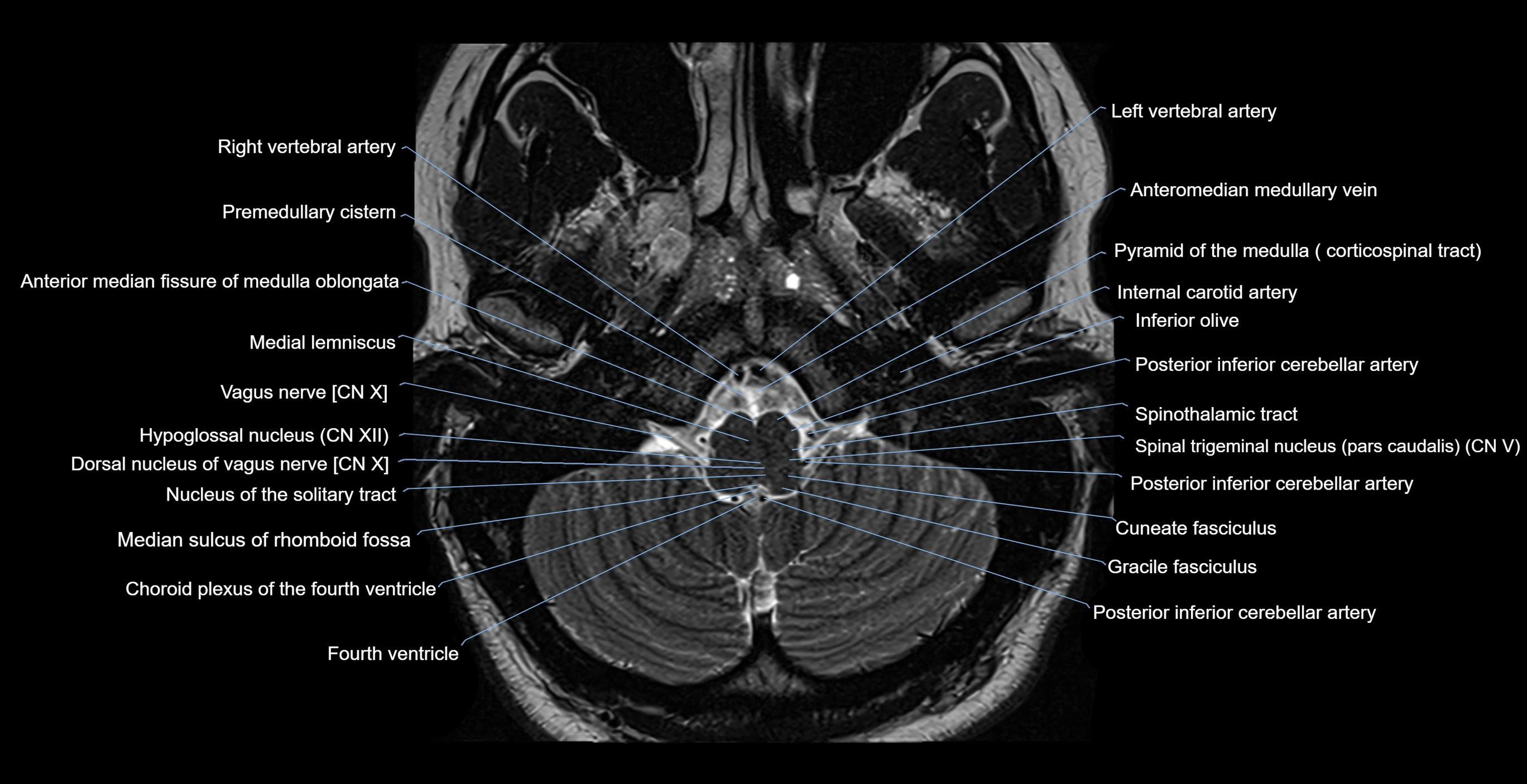 MRI-brainstem-&-basal-ganglia-anatomy-labelled-3T-MRI-images-00007.webp