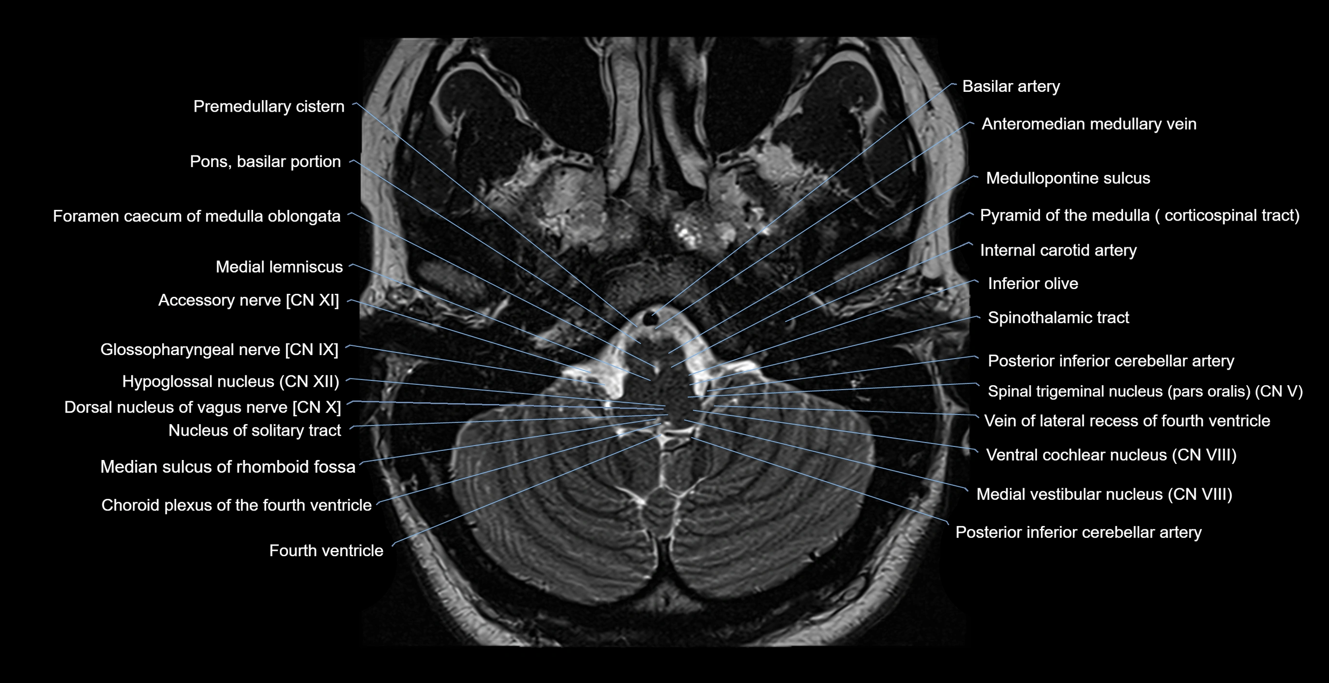 MRI-brainstem-&-basal-ganglia-anatomy-labelled-3T-MRI-images-00008.webp