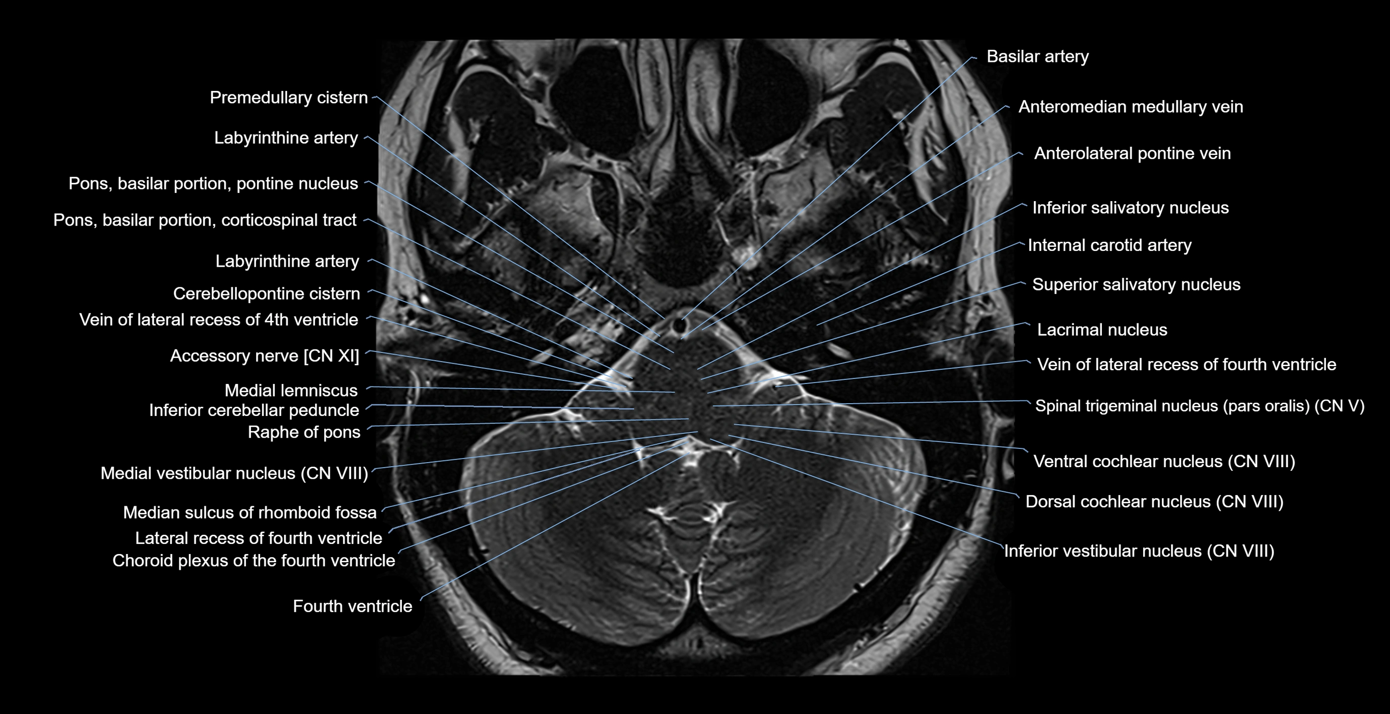 MRI-brainstem-&-basal-ganglia-anatomy-labelled-3T-MRI-images-00010.webp