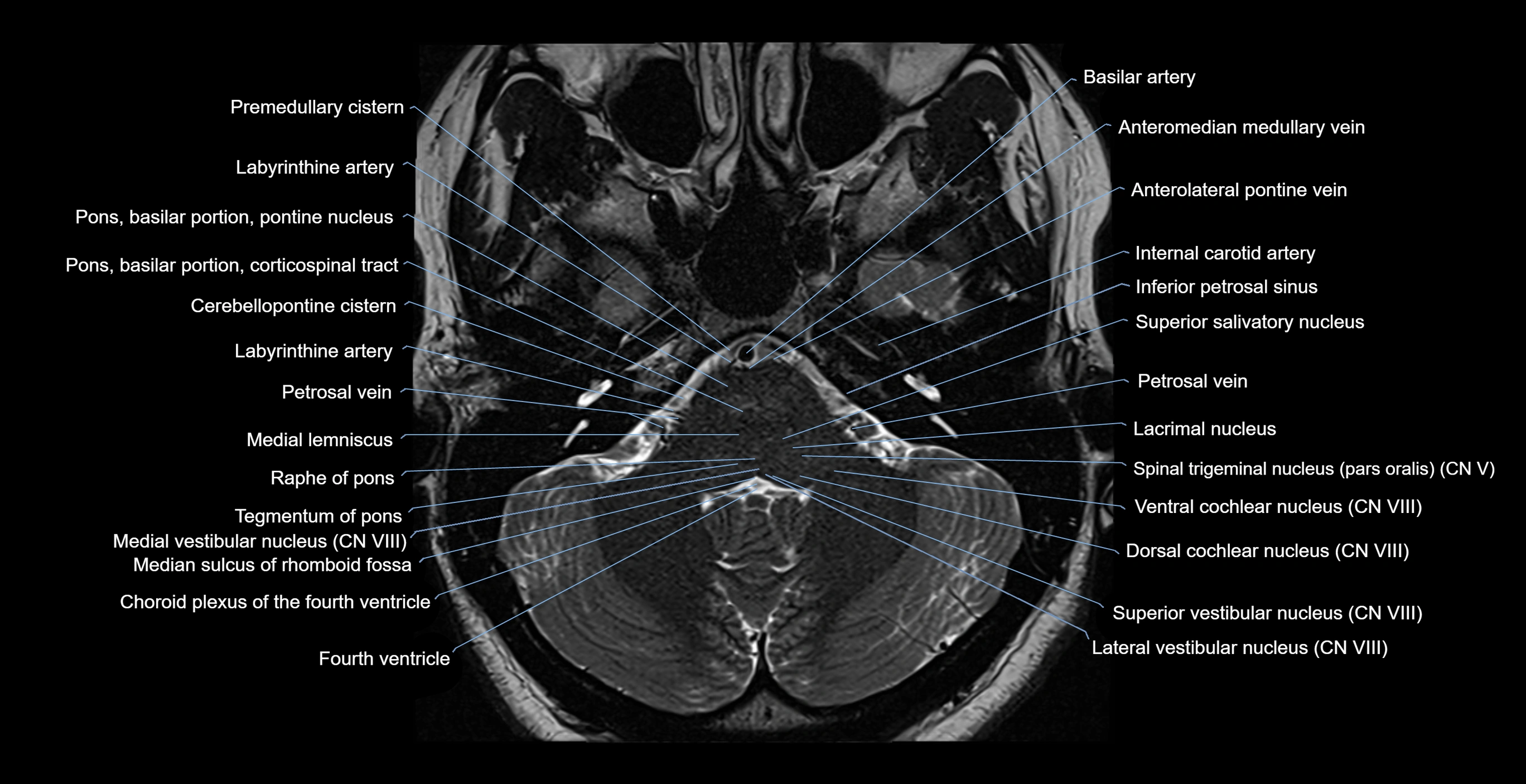 MRI-brainstem-&-basal-ganglia-anatomy-labelled-3T-MRI-images-00011.webp